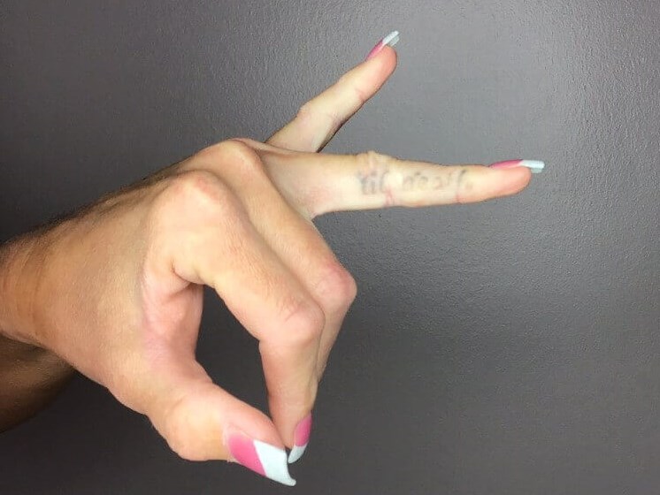 Tattoo Removal Post 3 Sessions After