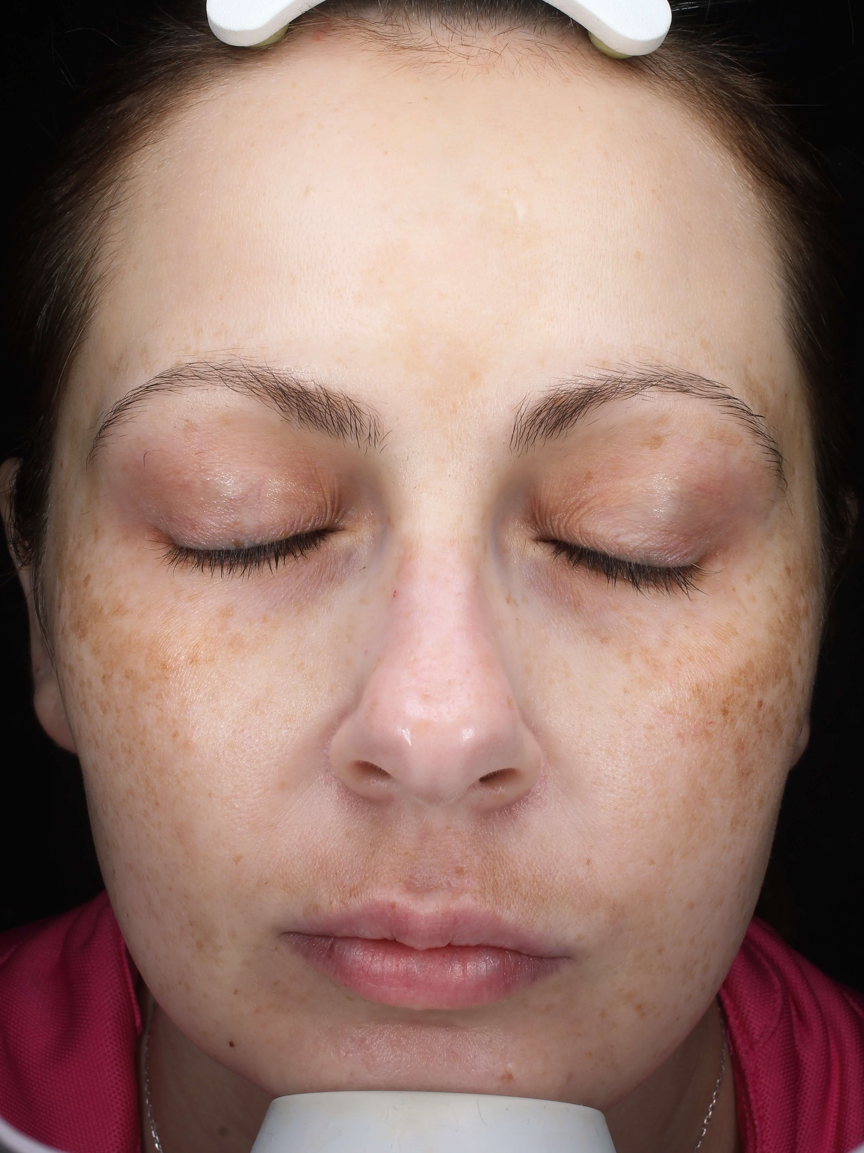 Skin Improved with HydraFacial After Picogenesis/HydraFacial