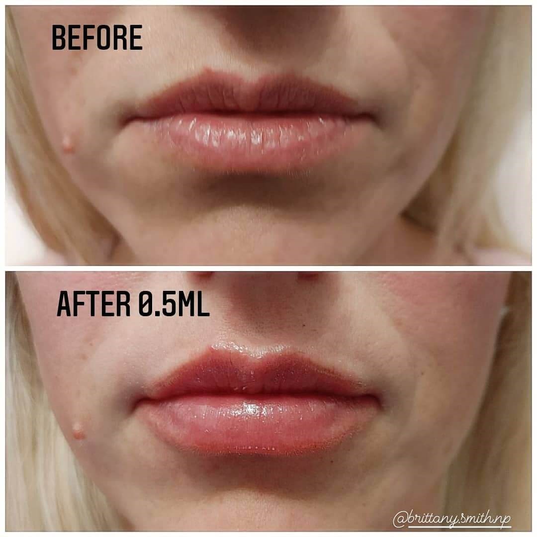 Lip enhancement with fillers Before