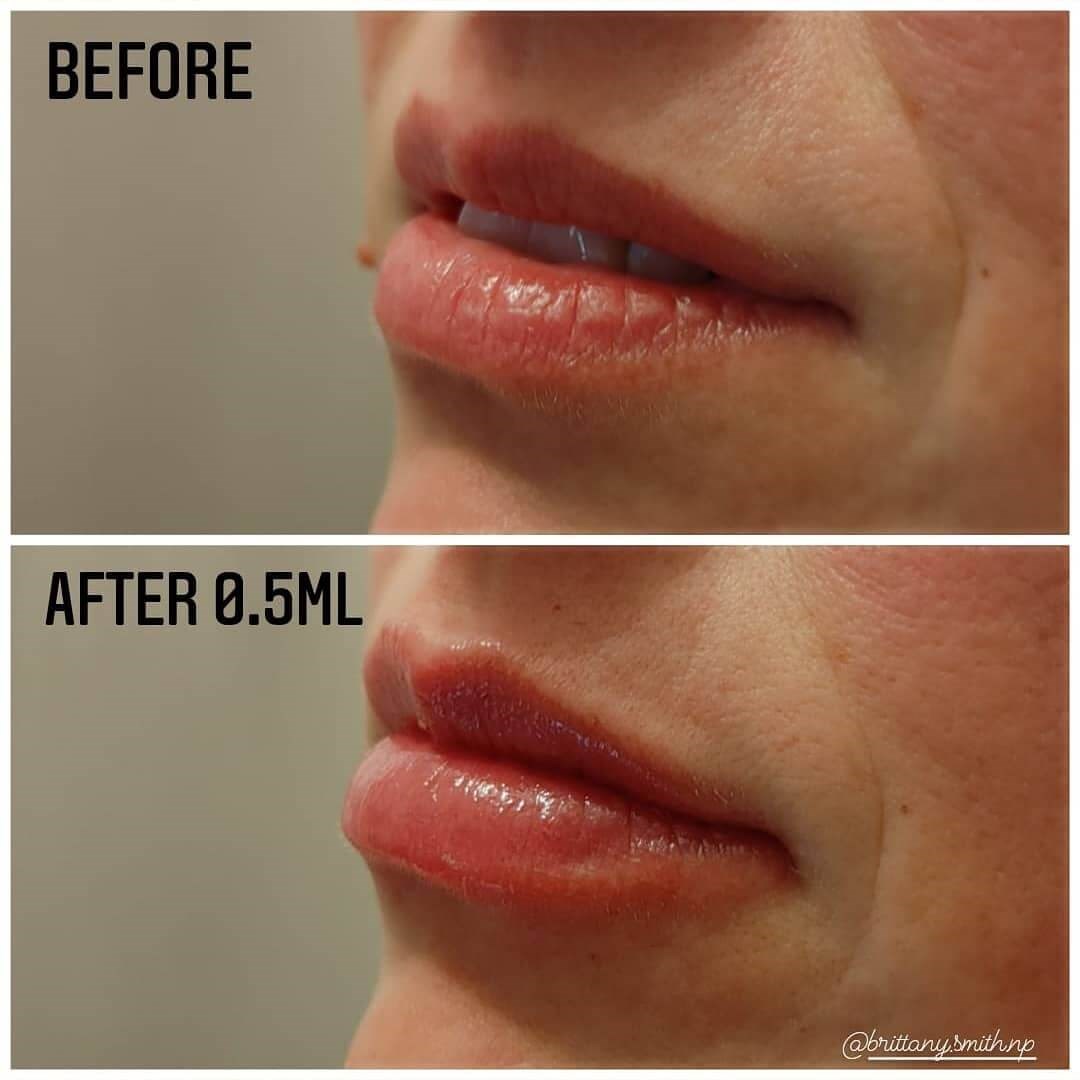 Lip enhancement with fillers After