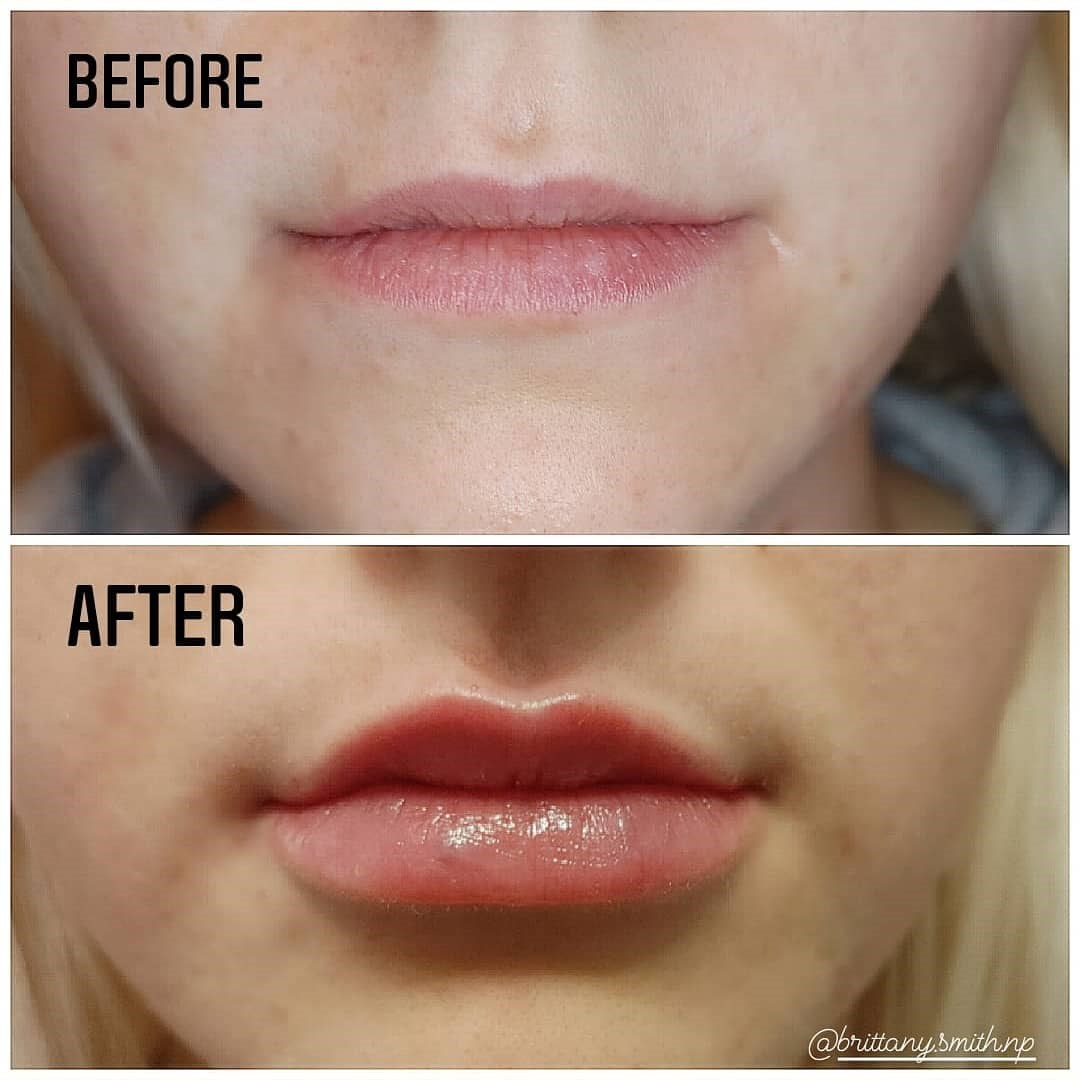 Lip enhancement with fillers Before