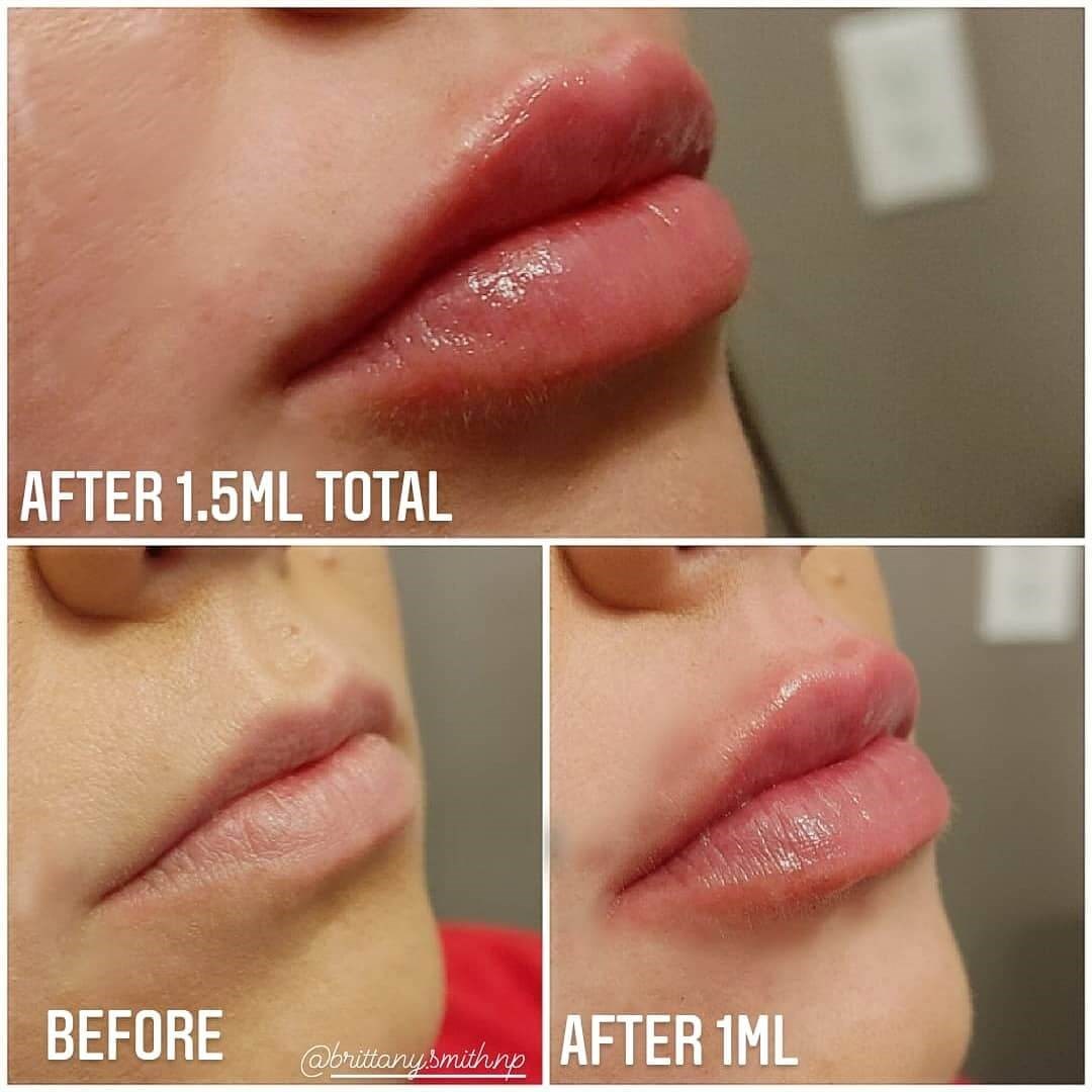 Lip enhancement with fillers After