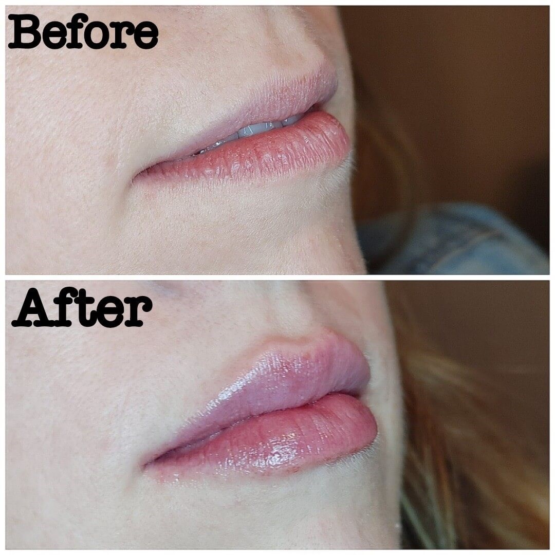 Lip enhancement with fillers Before