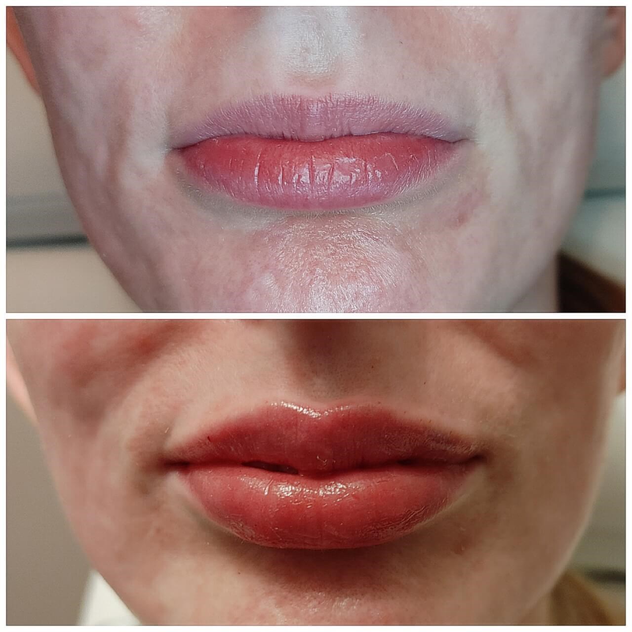 Lip enhancement with fillers After
