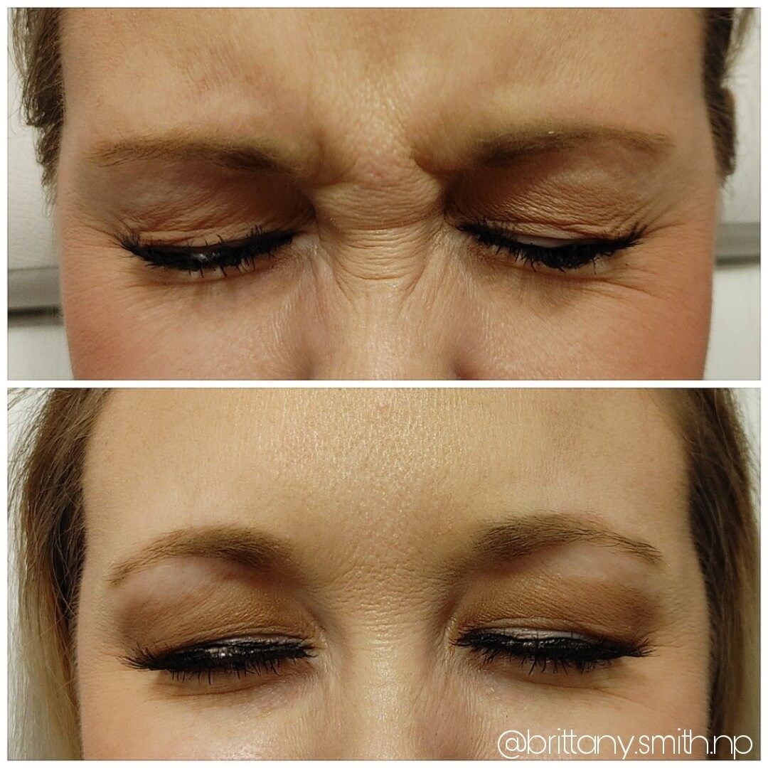 Wrinkle reduction treatment Before
