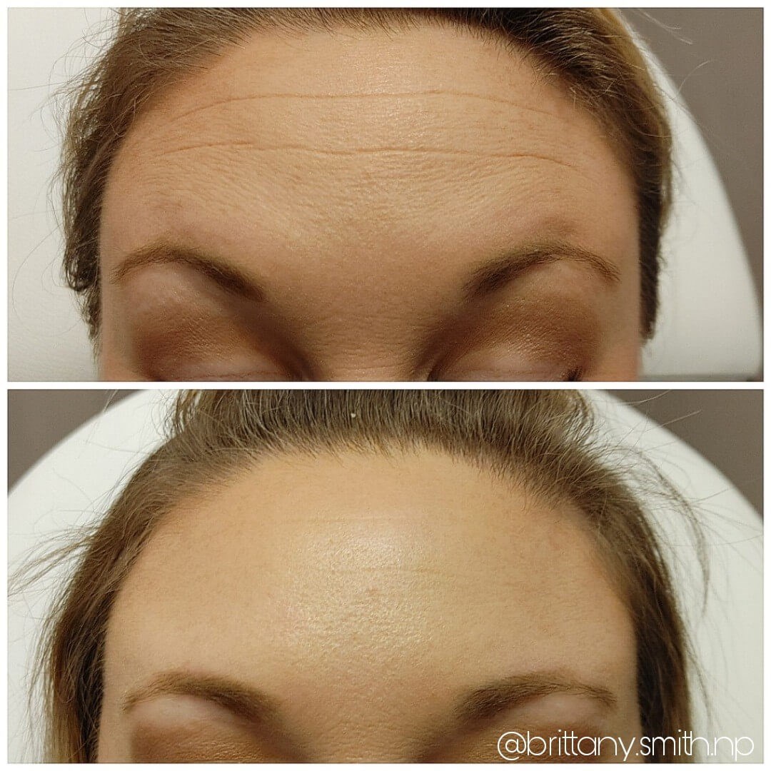 Wrinkle reduction treatment After