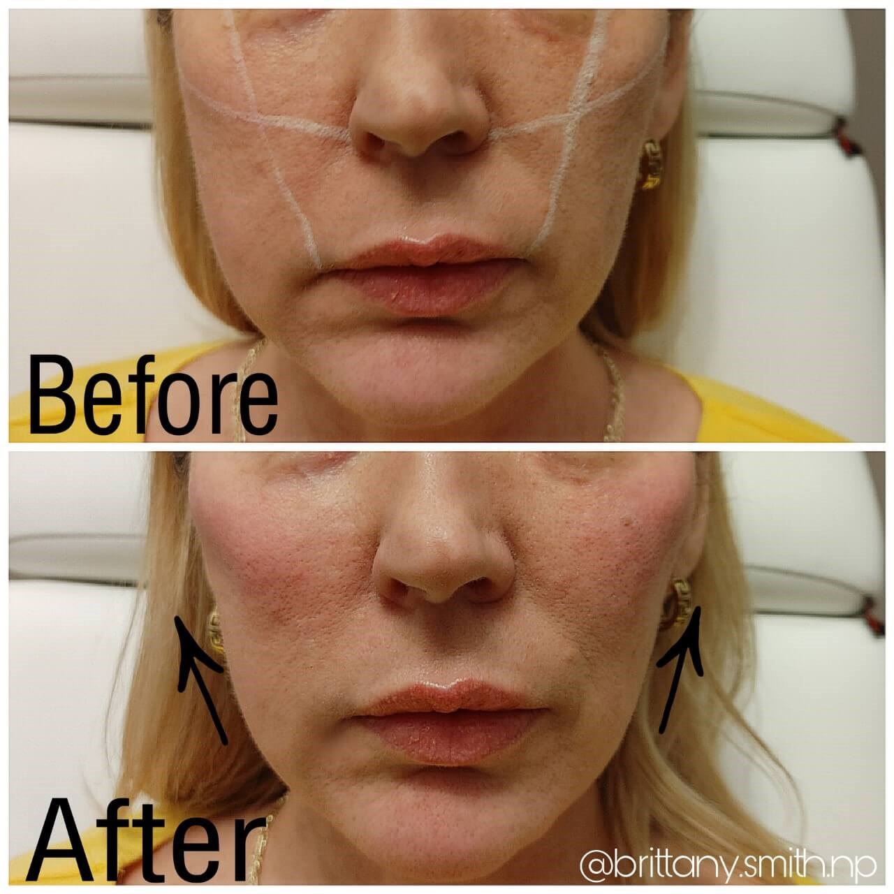 Liquid Facelift Before