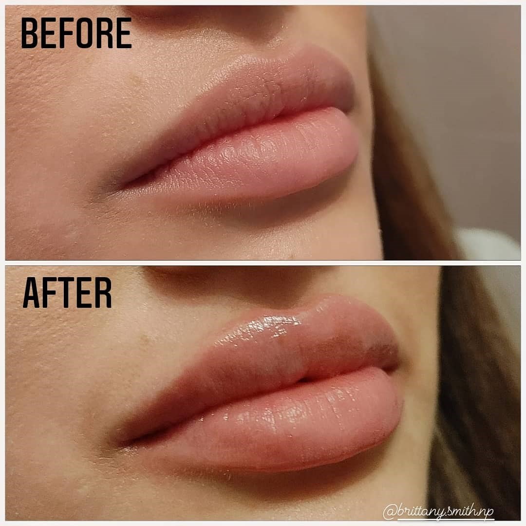 Lip enhancement with fillers Before
