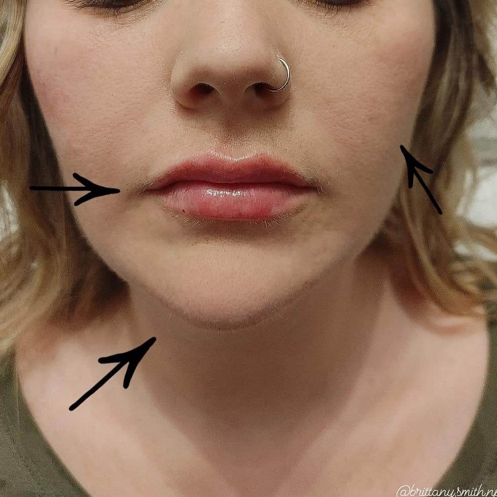 Facial Contouring with Fillers After