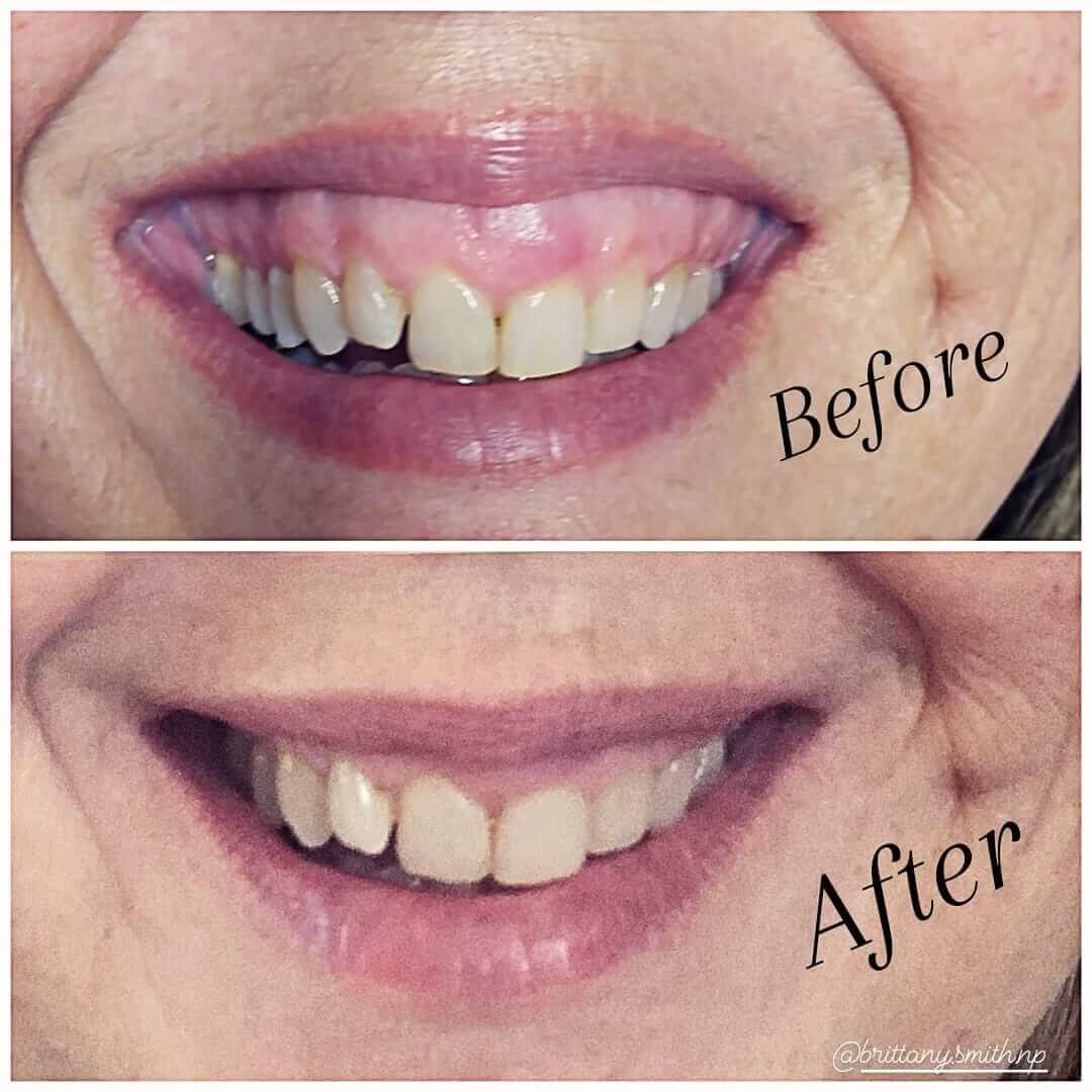Gummy Smile Reduction Before