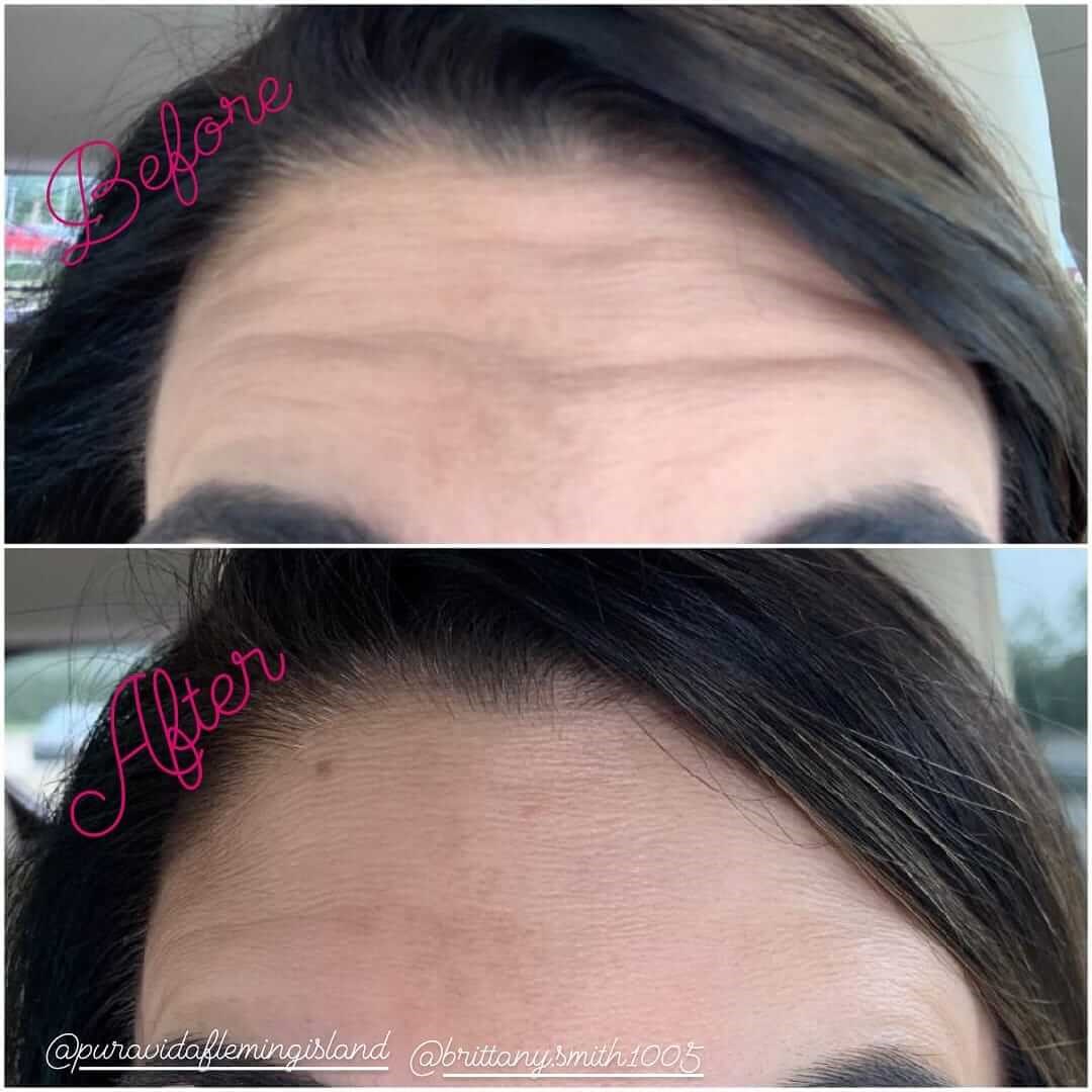 Wrinkle Reduction Before