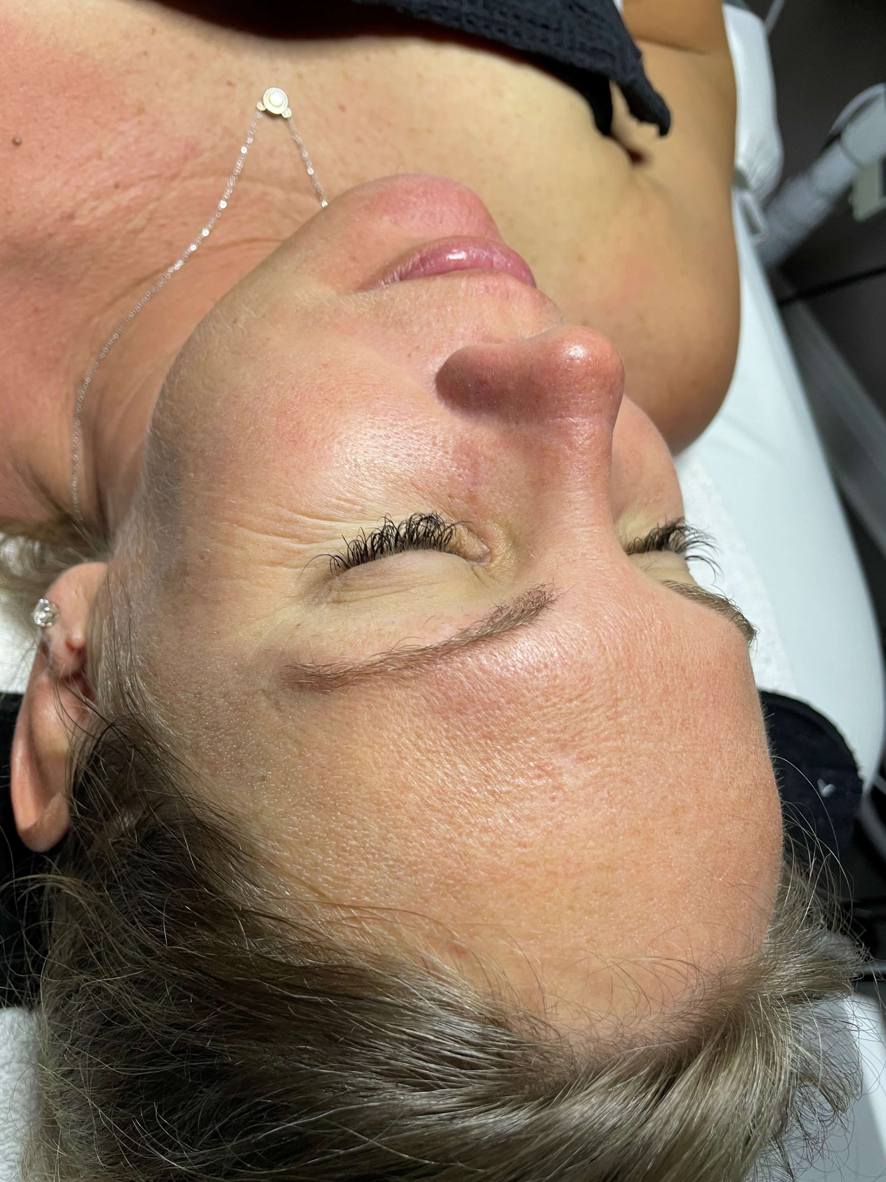 SaltFacial-Best Medical Facial Before