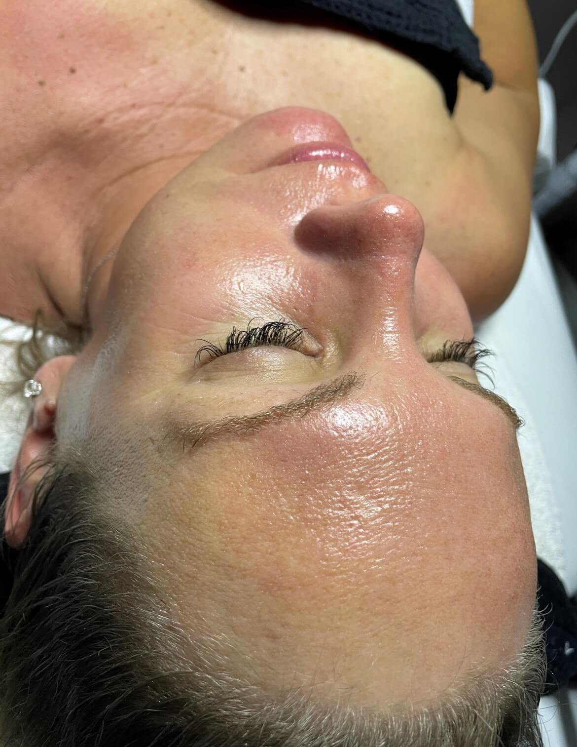 SaltFacial-Best Medical Facial After
