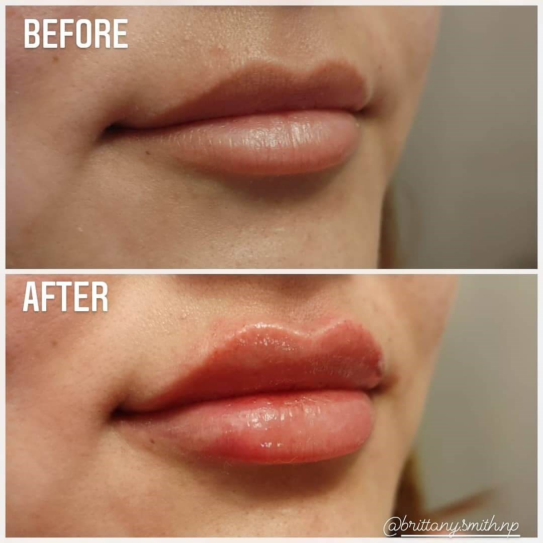 Lip enhancement with fillers Before