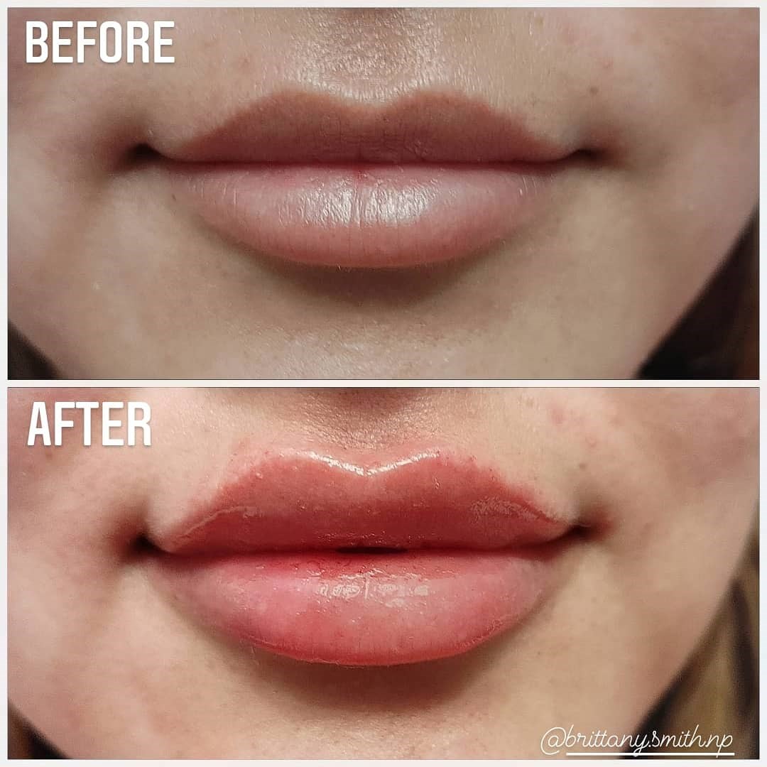 Lip enhancement with fillers After