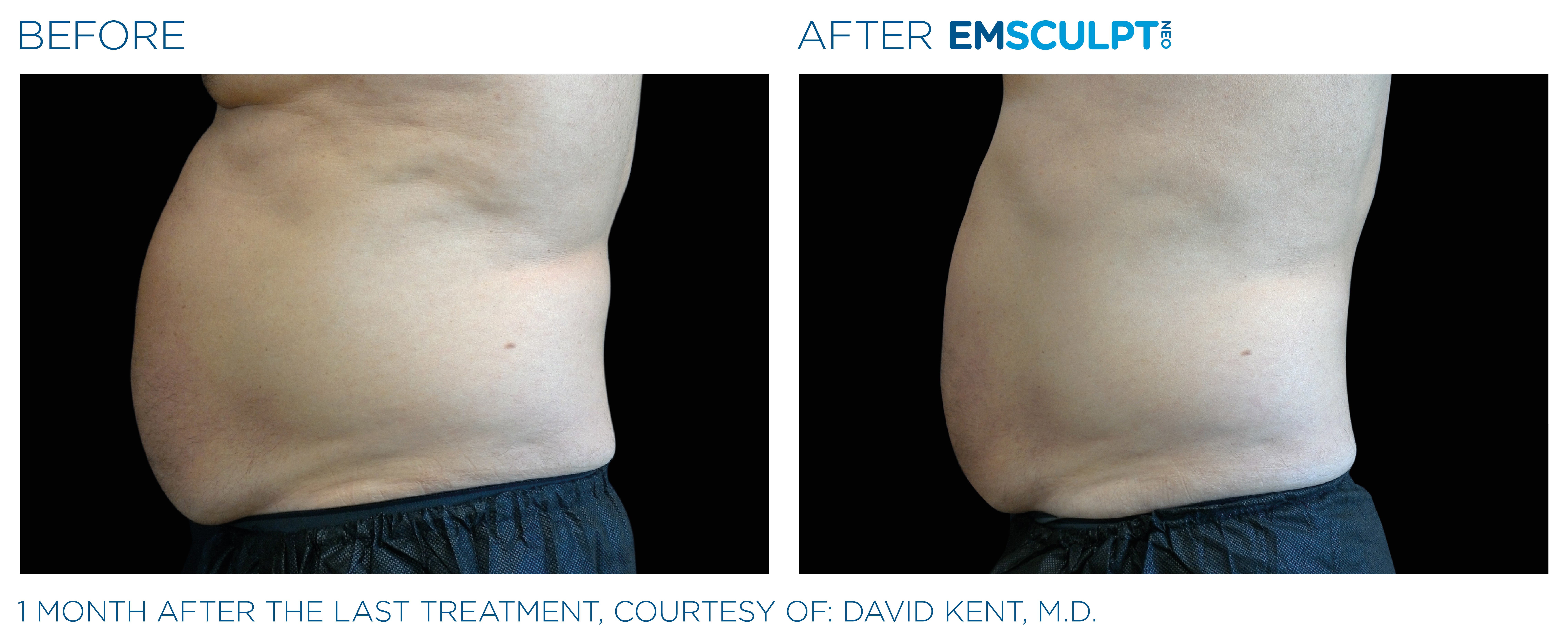 Male & Abdomen Improvement Before & After
