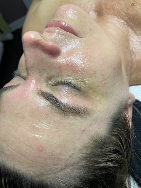 Skin Tightening After