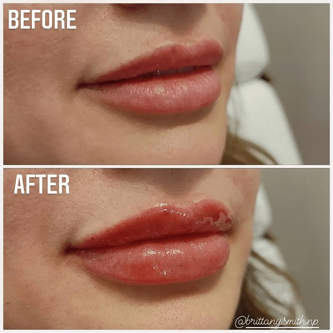 Lip Filler Before