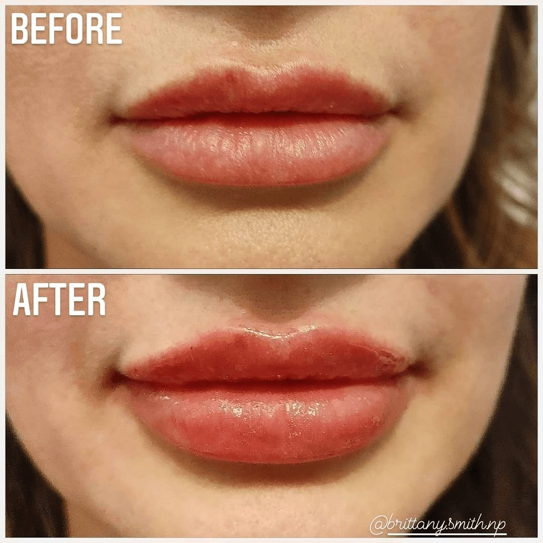 Lip Filler After