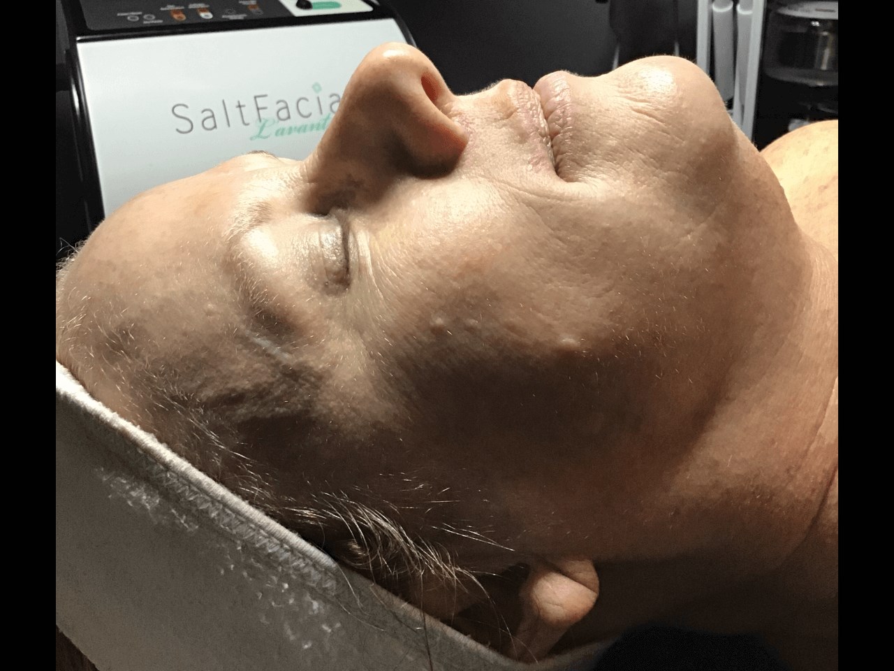 Skin Tightening Before