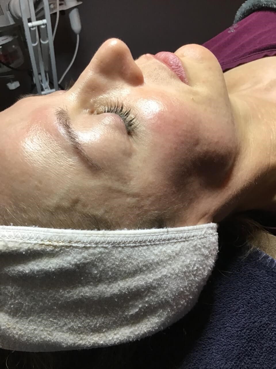 Glow/Skin tightening Before
