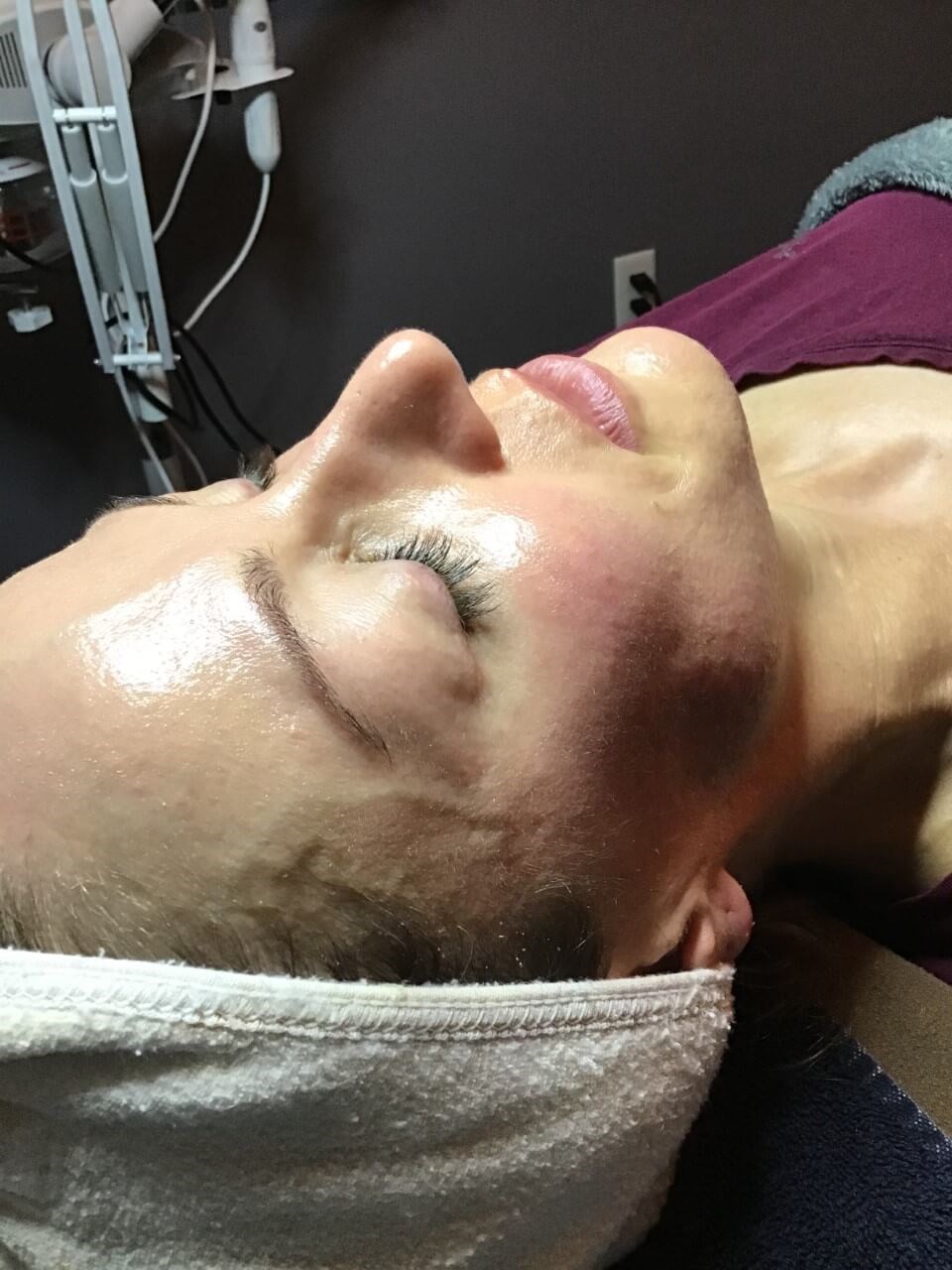 Glow/Skin tightening After