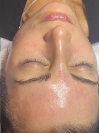 DiamondGlow & SkinMedica After