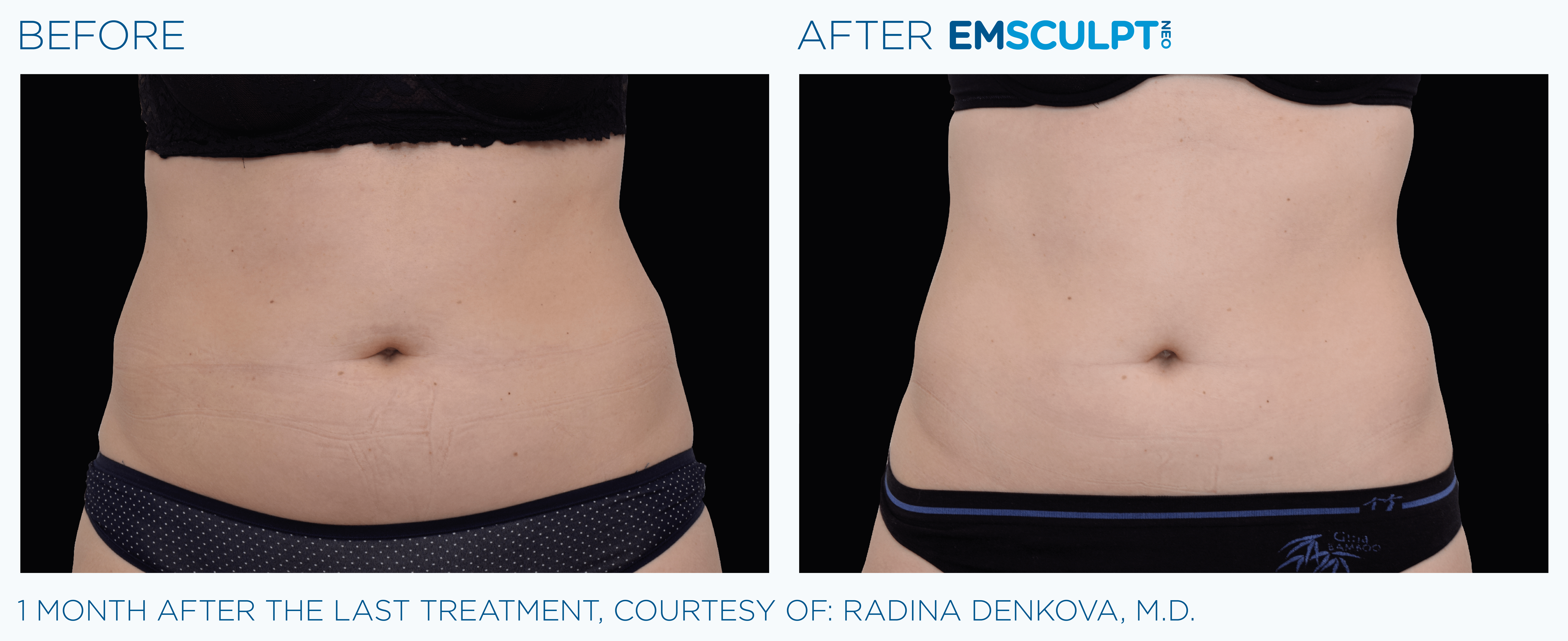 Male & Abdomen Improvement Before & After Same Photo