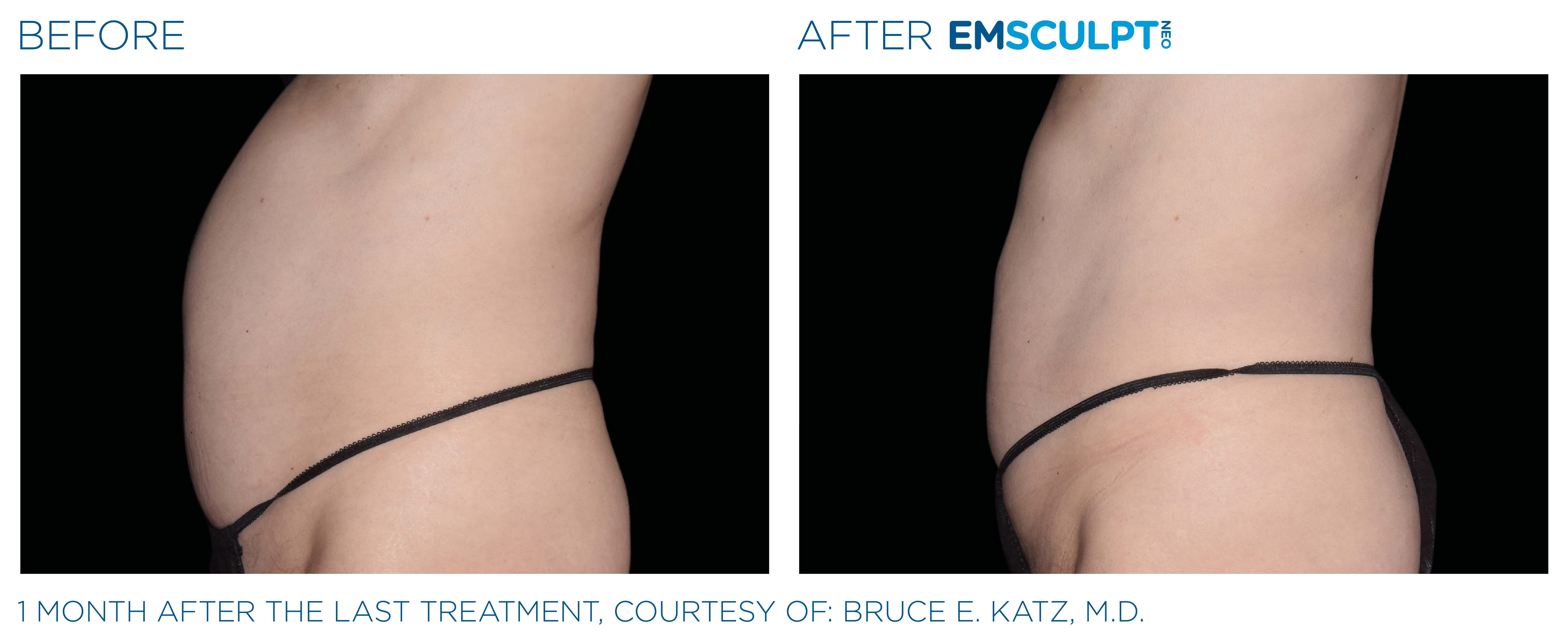 FEMALE ABDOMEN IMPROVEMENT Before & After