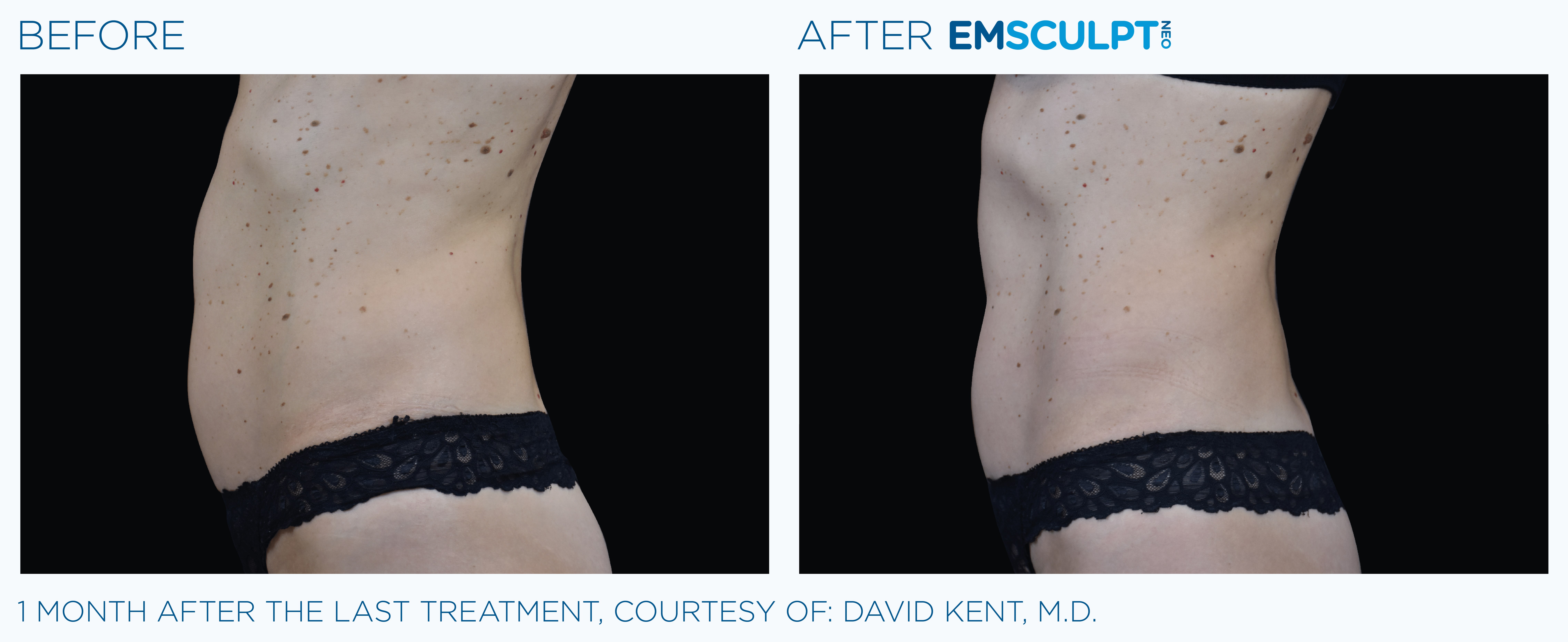 FEMALE ABDOMEN IMPROVEMENT Before & After