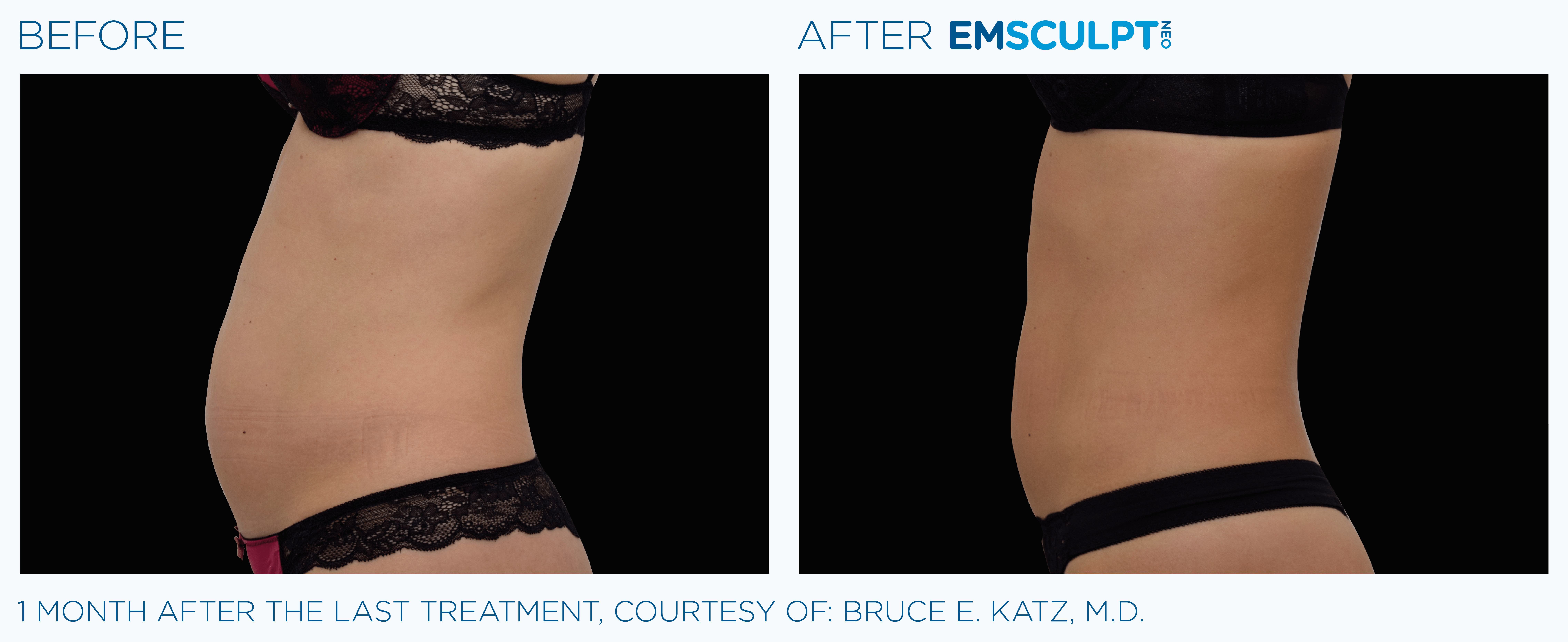 FEMALE ABDOMEN IMPROVEMENT Before & After