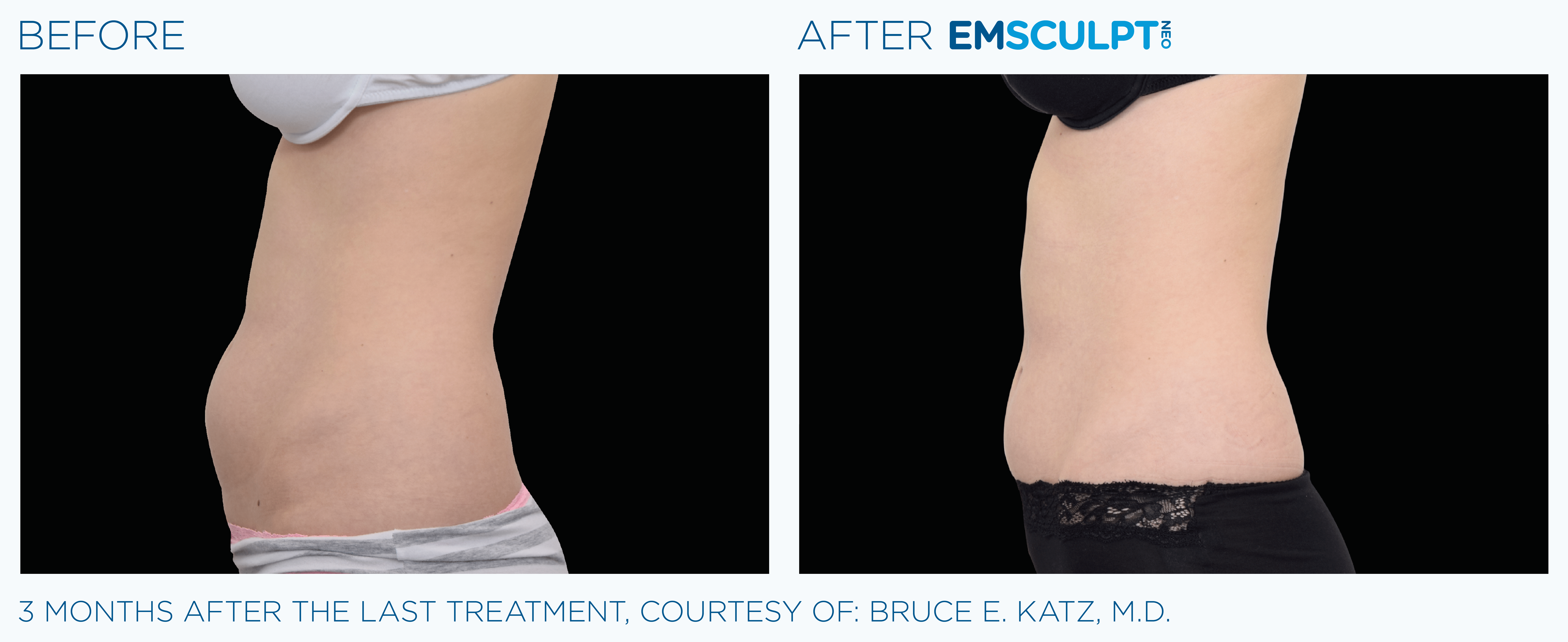 FEMALE ABDOMEN IMPROVEMENT Before & After