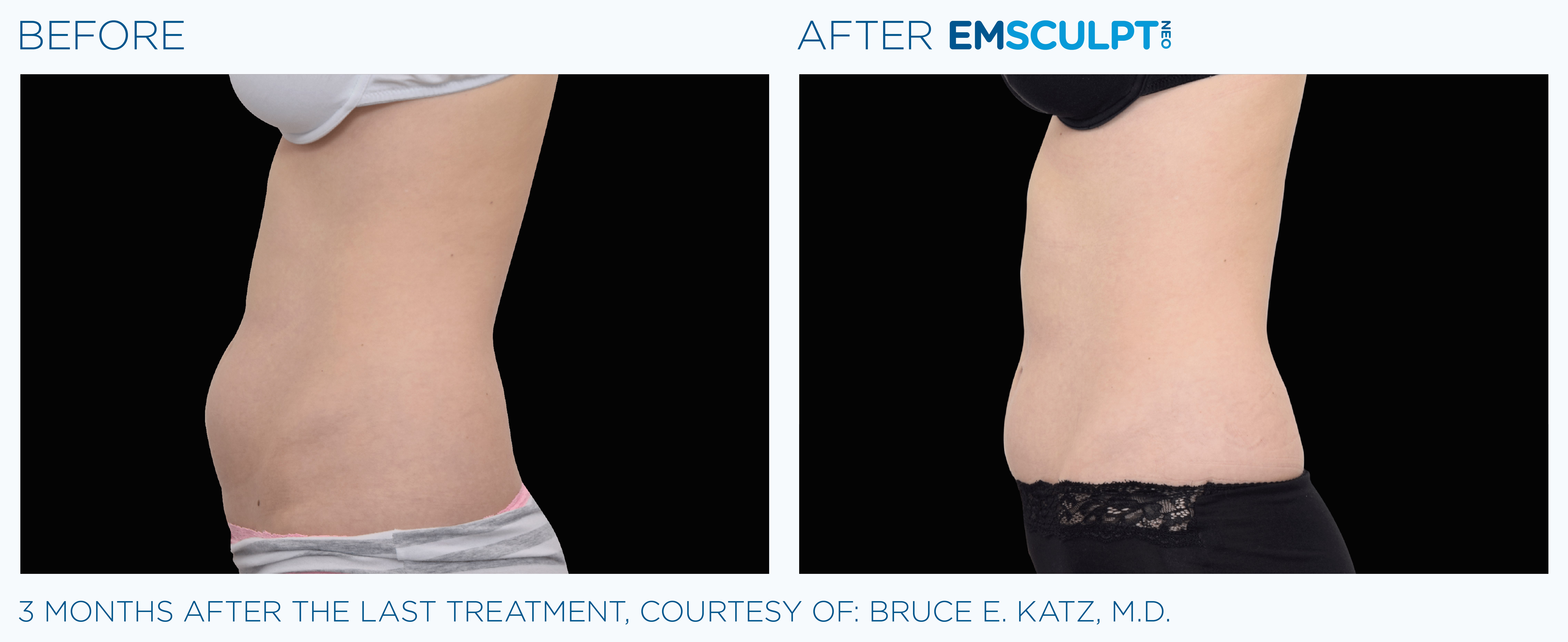 FEMALE ABDOMEN IMPROVEMENT Before & After