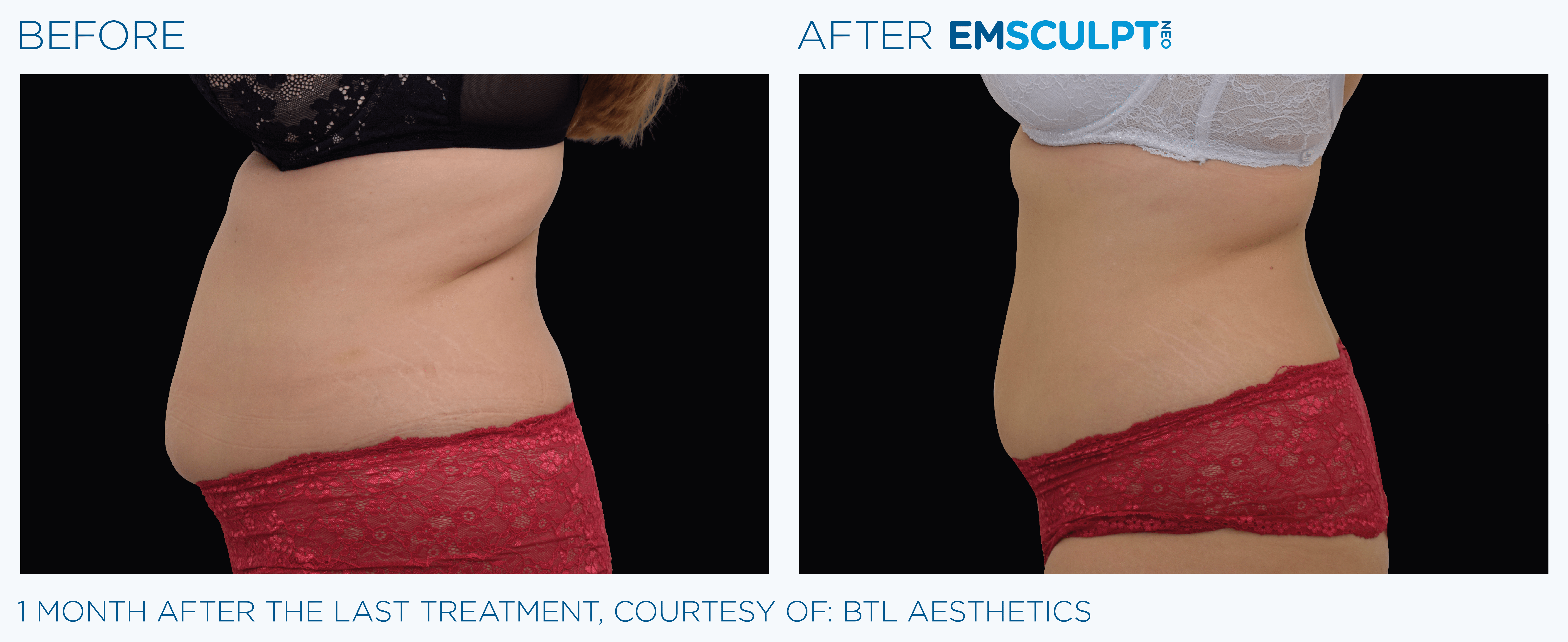 FEMALE ABDOMEN IMPROVEMENT Before & After