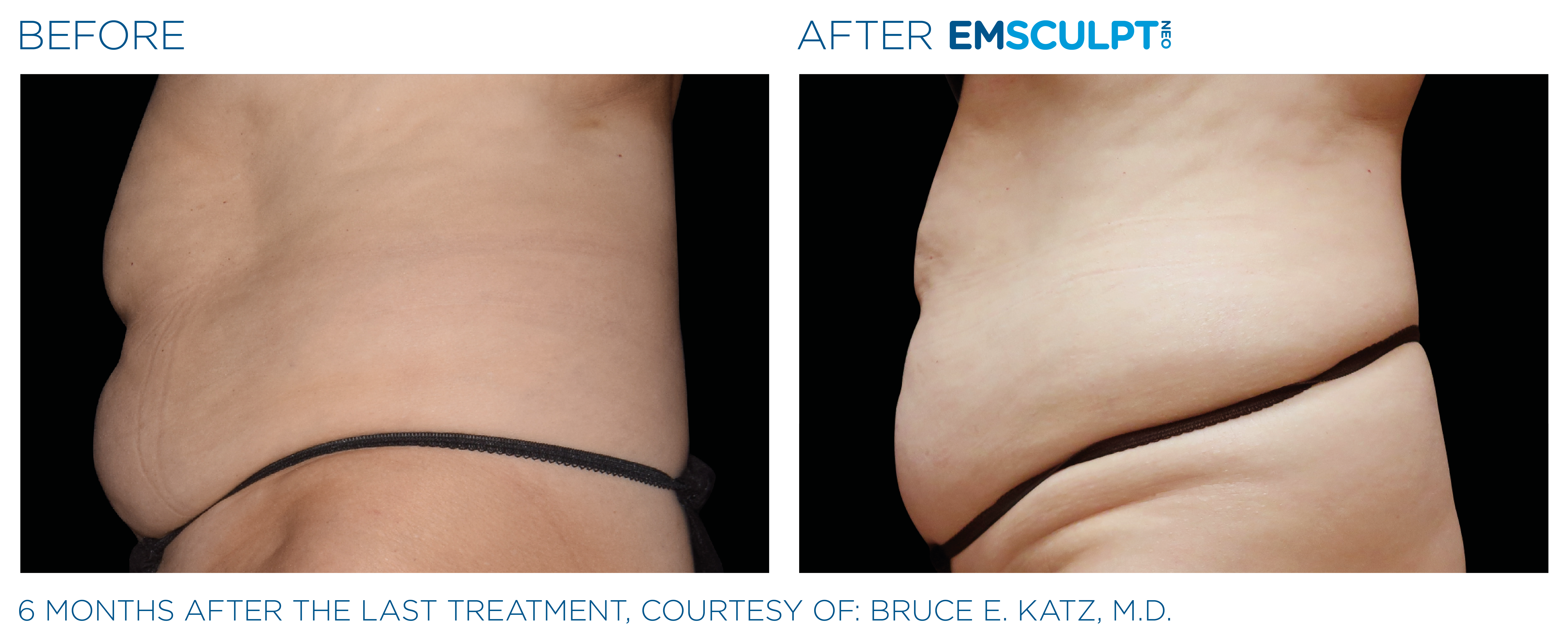 FEMALE ABDOMEN IMPROVEMENT Before & After