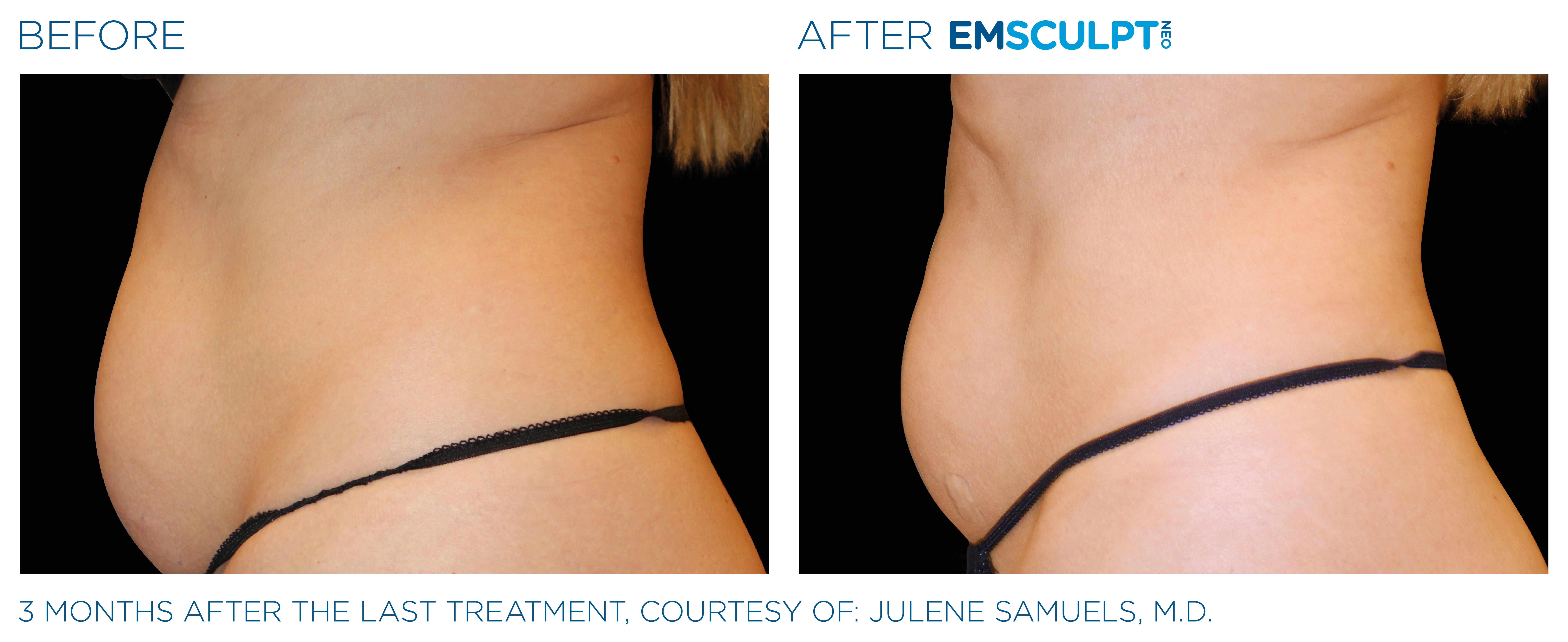 FEMALE ABDOMEN IMPROVEMENT Before & After