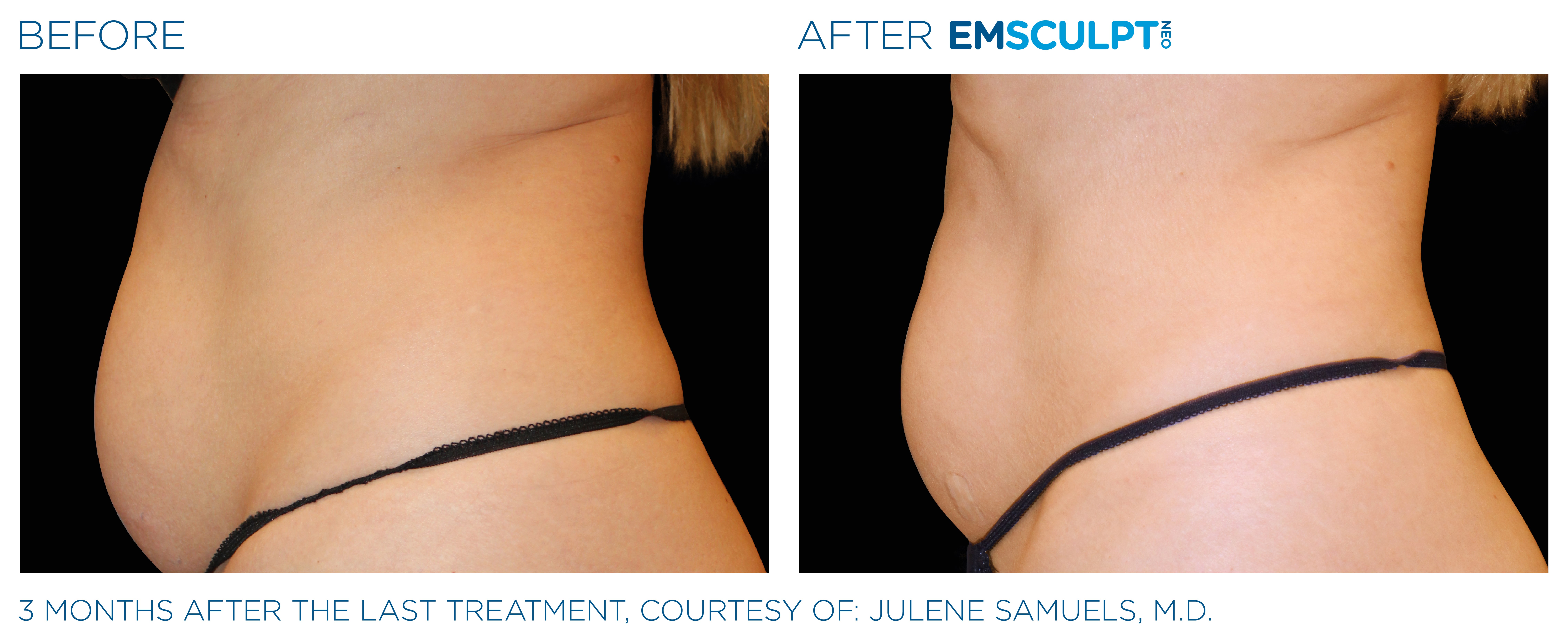 FEMALE ABDOMEN IMPROVEMENT Before & After