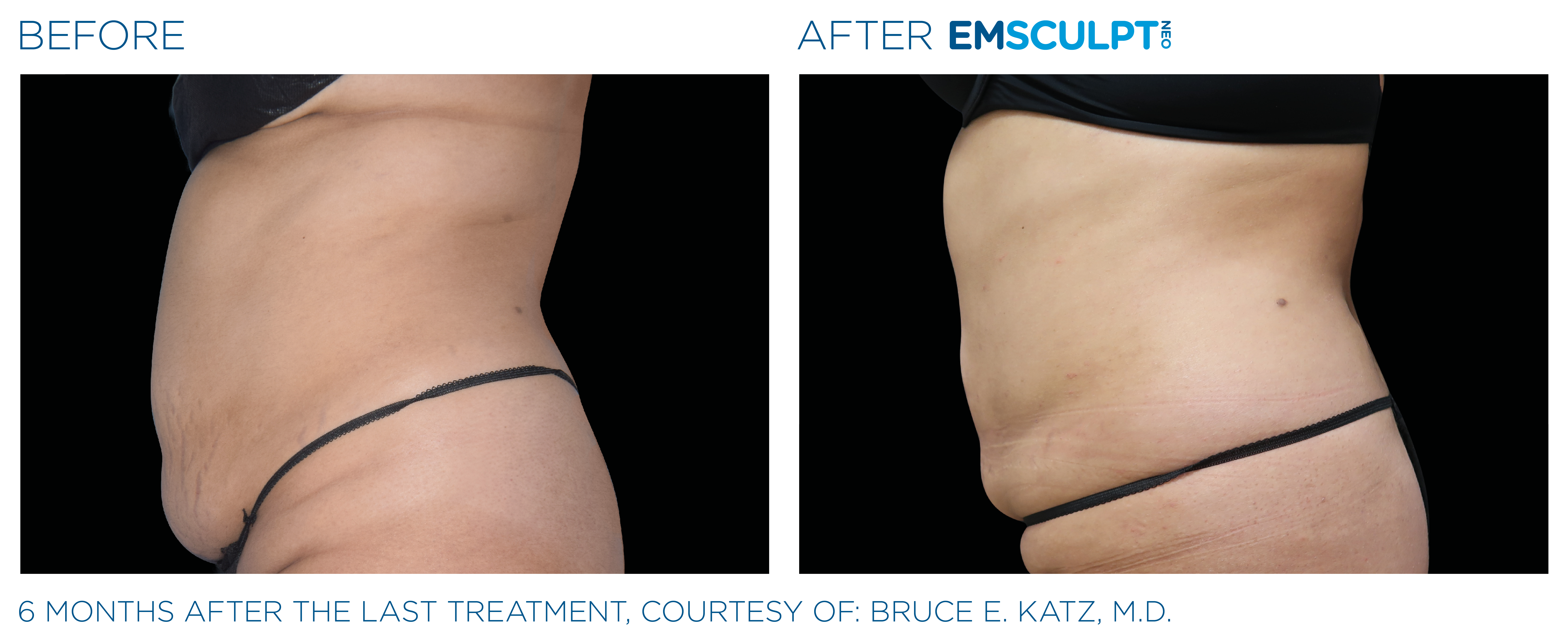 FEMALE ABDOMEN IMPROVEMENT Before & After