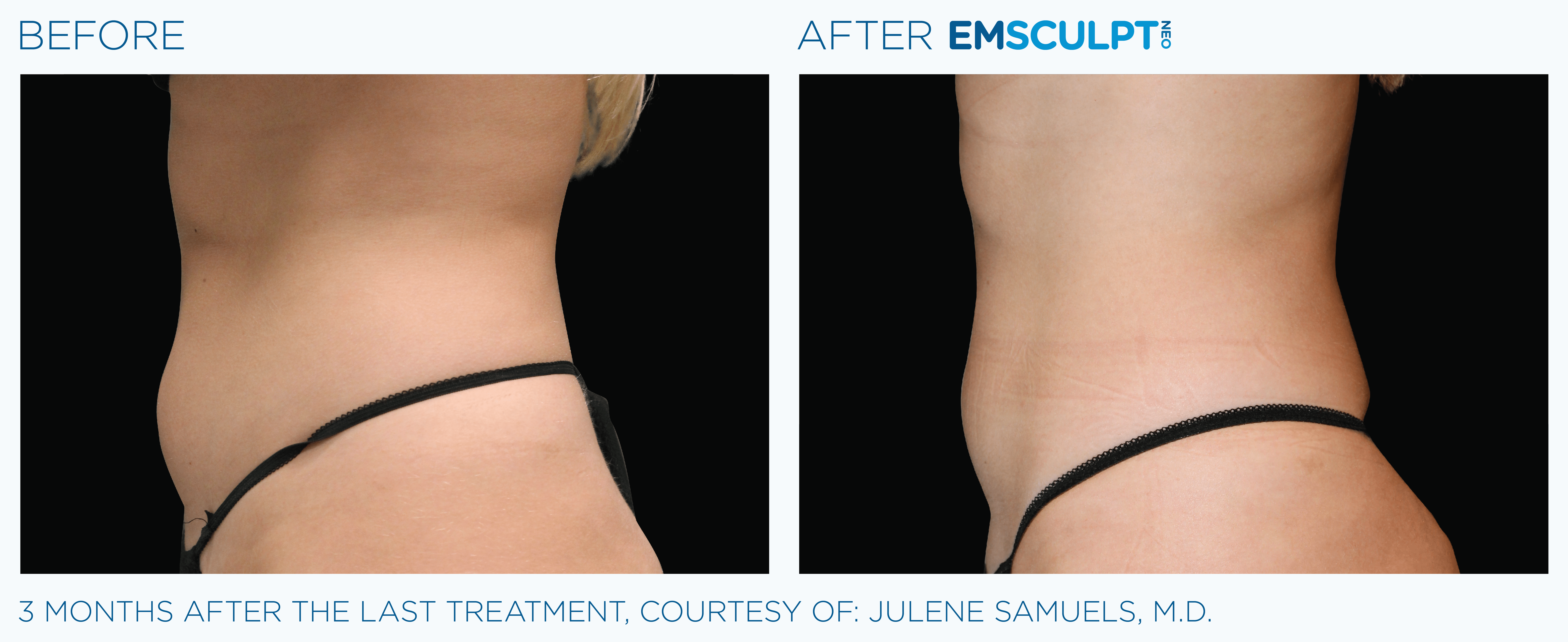 FEMALE ABDOMEN IMPROVEMENT Before & After