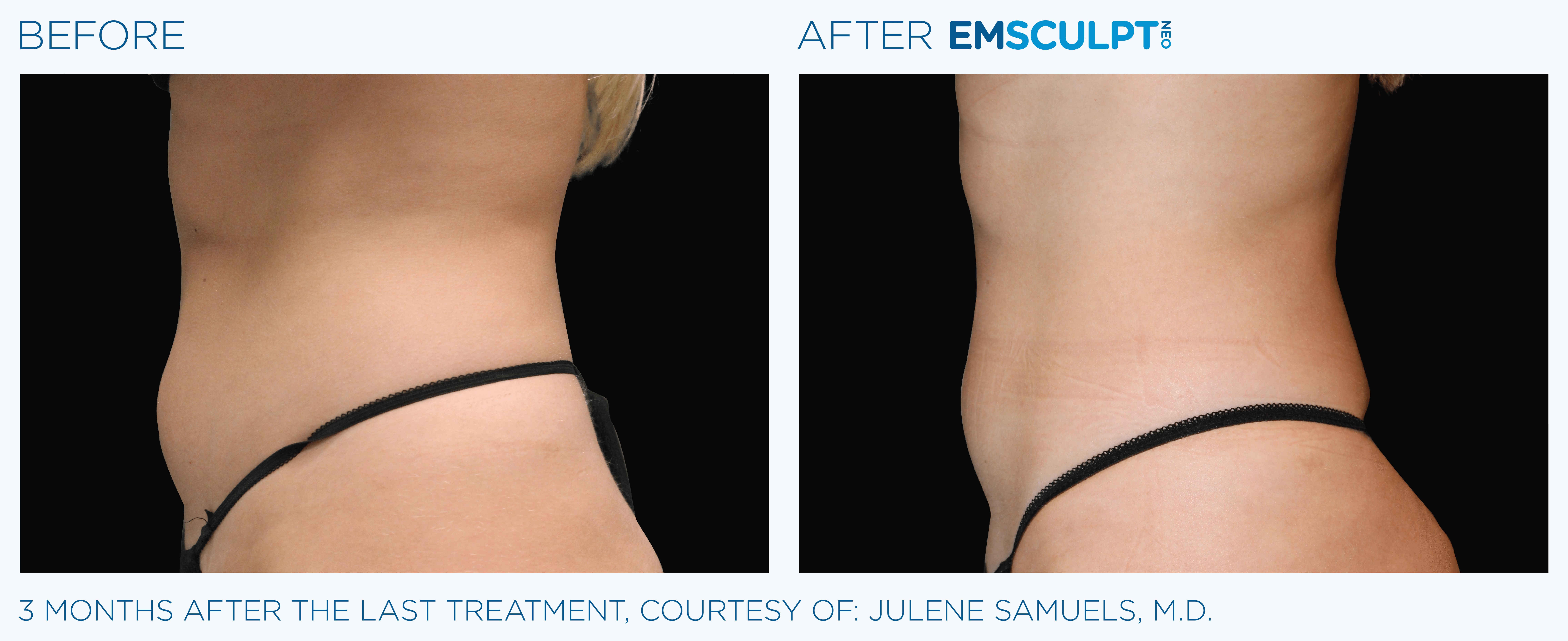 FEMALE ABDOMEN IMPROVEMENT Before & After