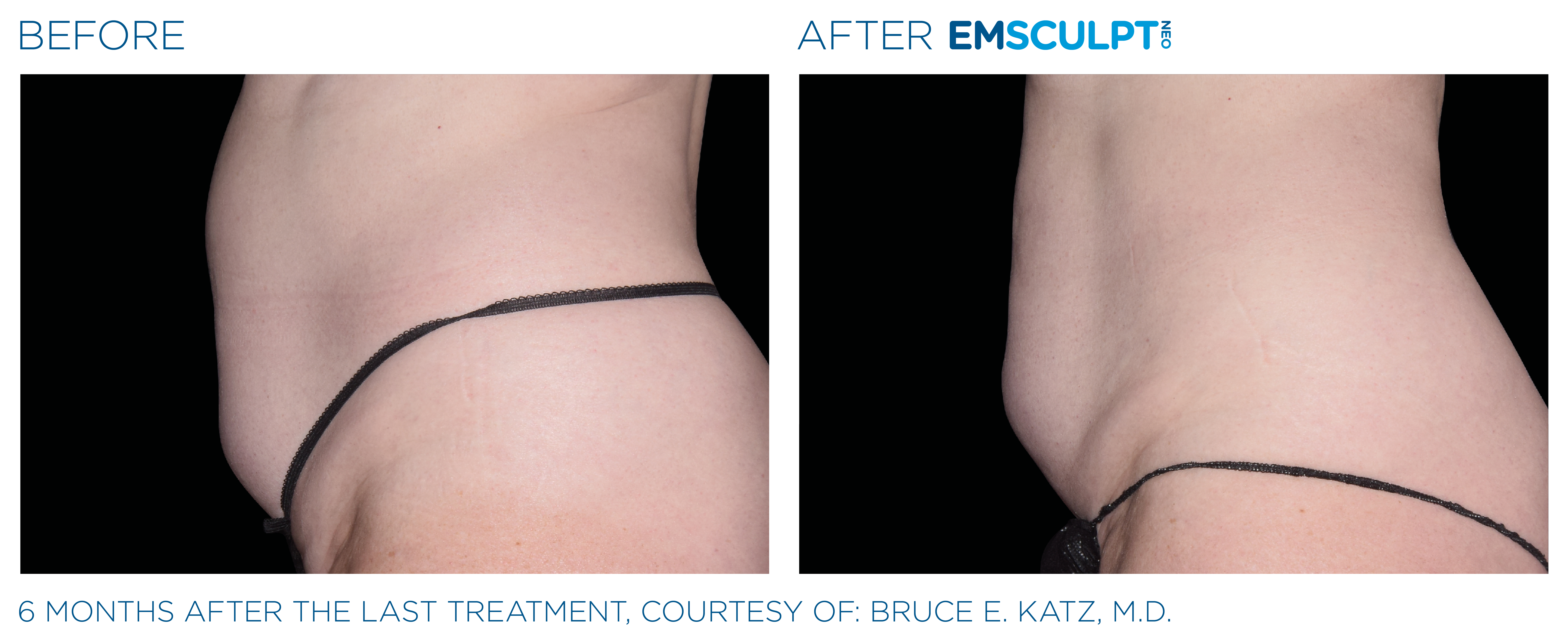 FEMALE ABDOMEN IMPROVEMENT Before & After