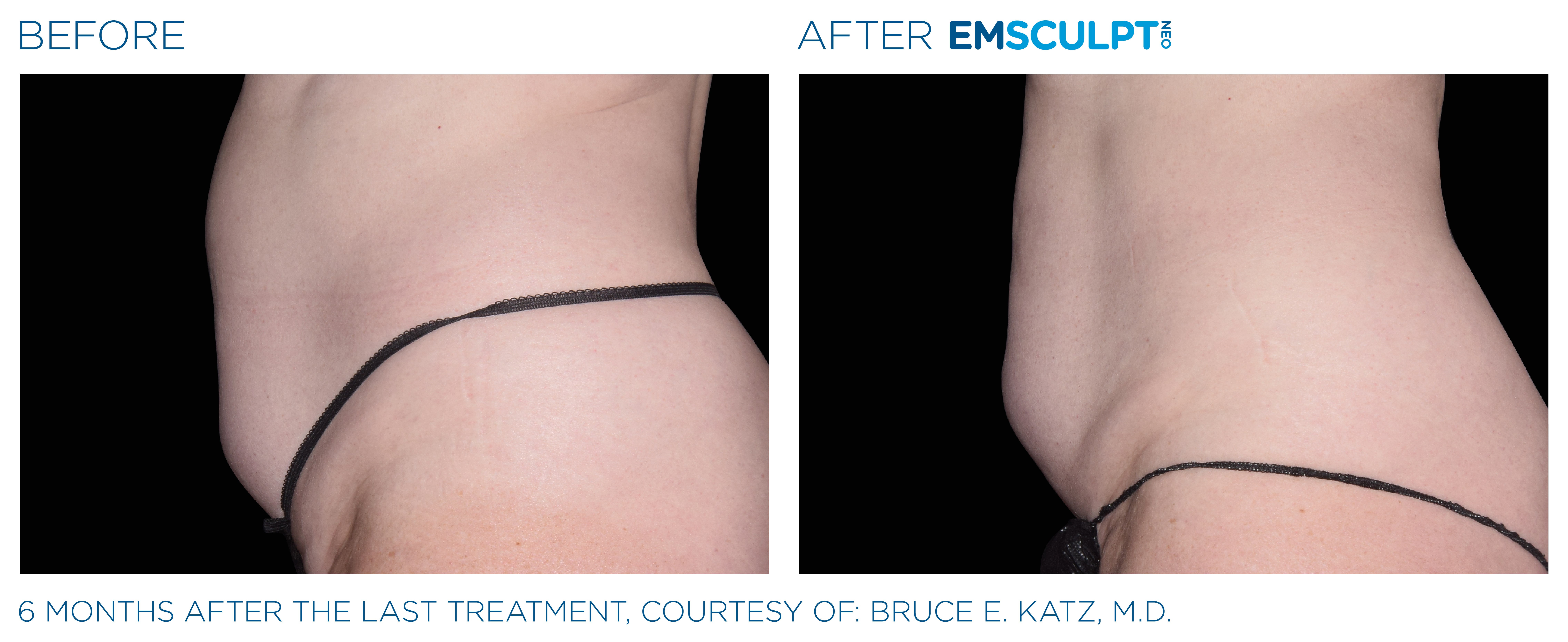 FEMALE ABDOMEN IMPROVEMENT Before & After