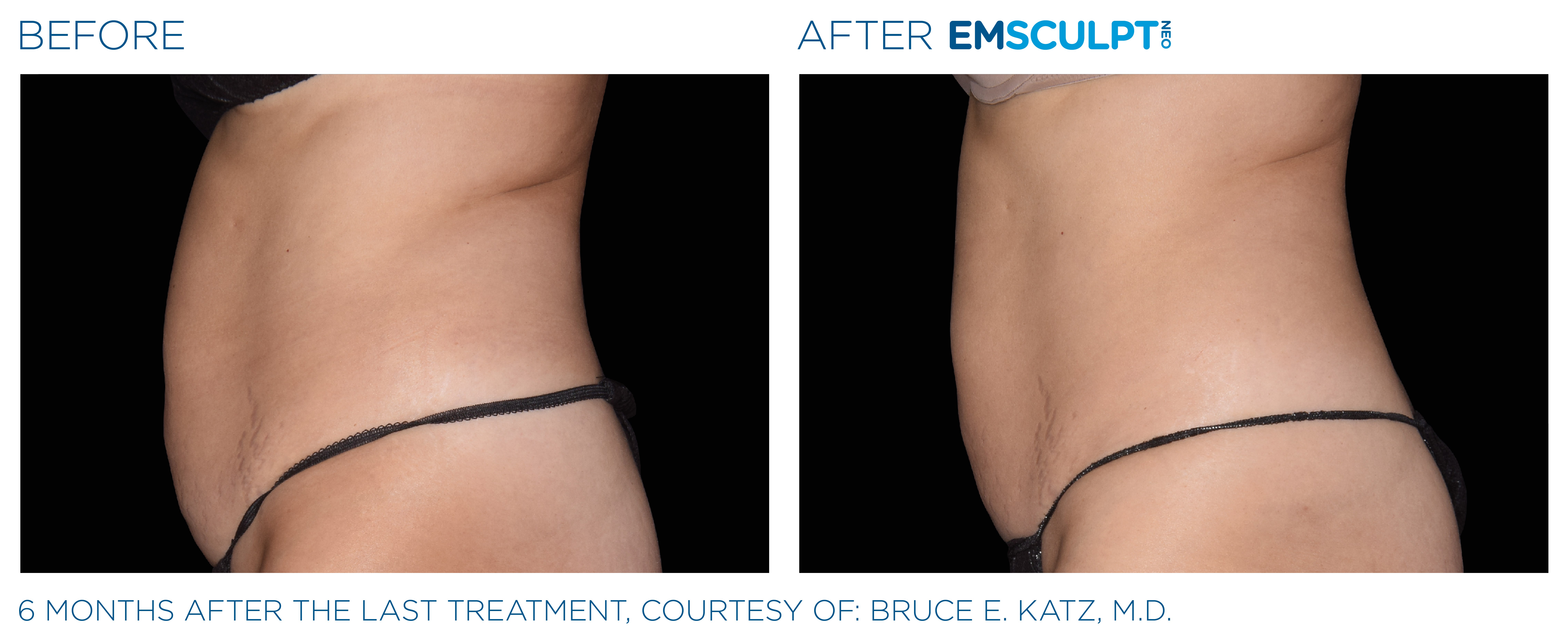 FEMALE ABDOMEN IMPROVEMENT Before & After