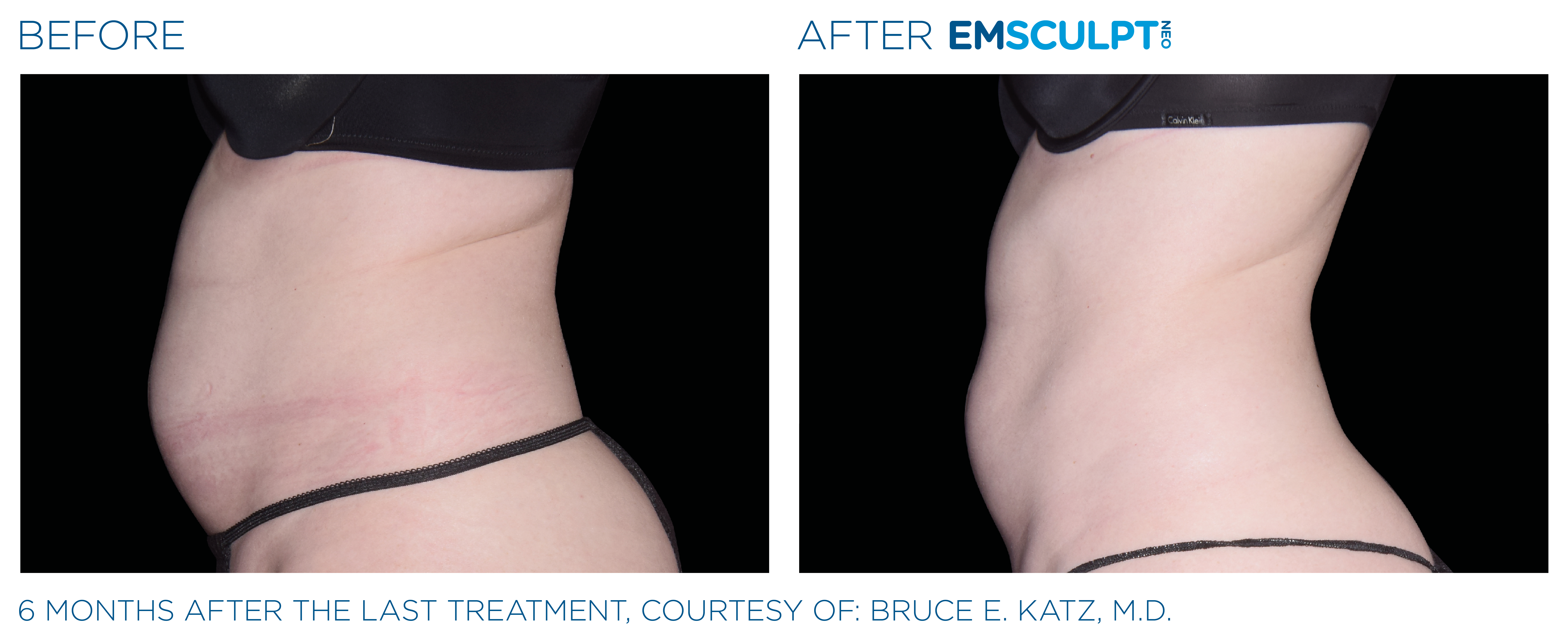 FEMALE ABDOMEN IMPROVEMENT Before & After