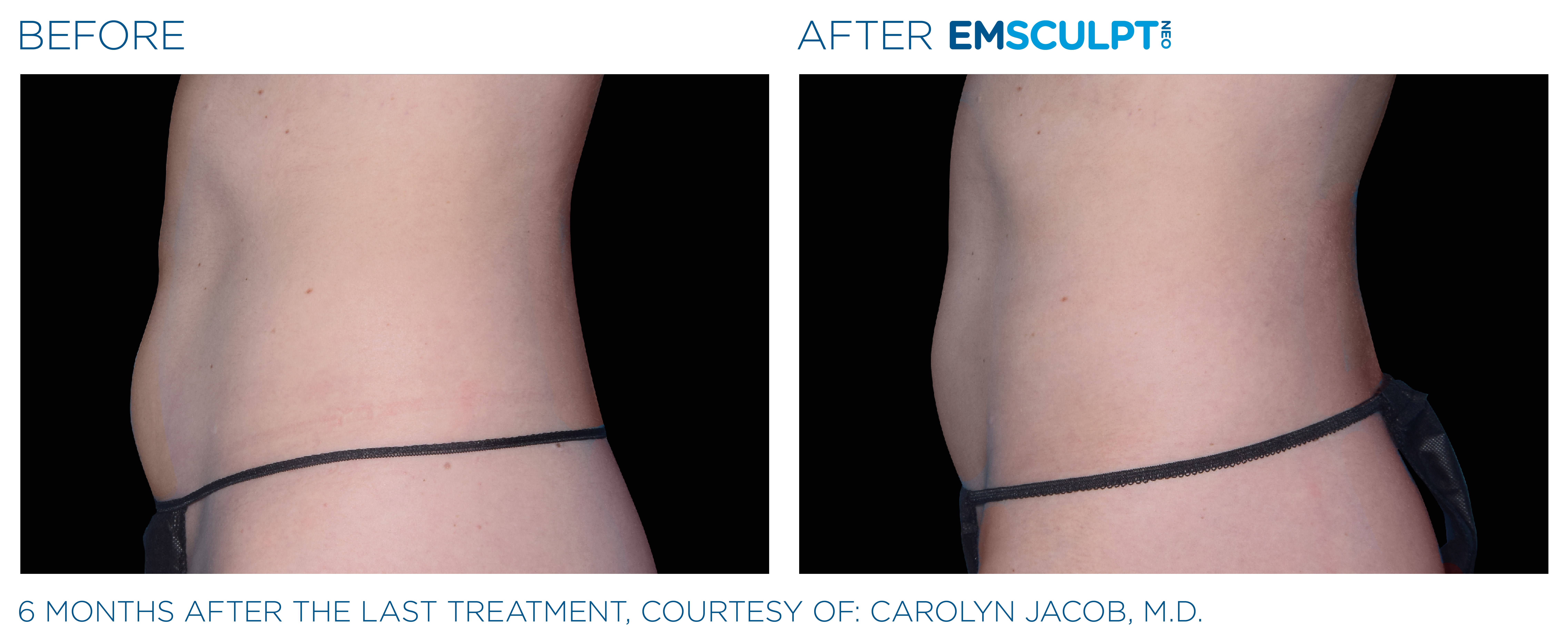 FEMALE ABDOMEN IMPROVEMENT Before & After