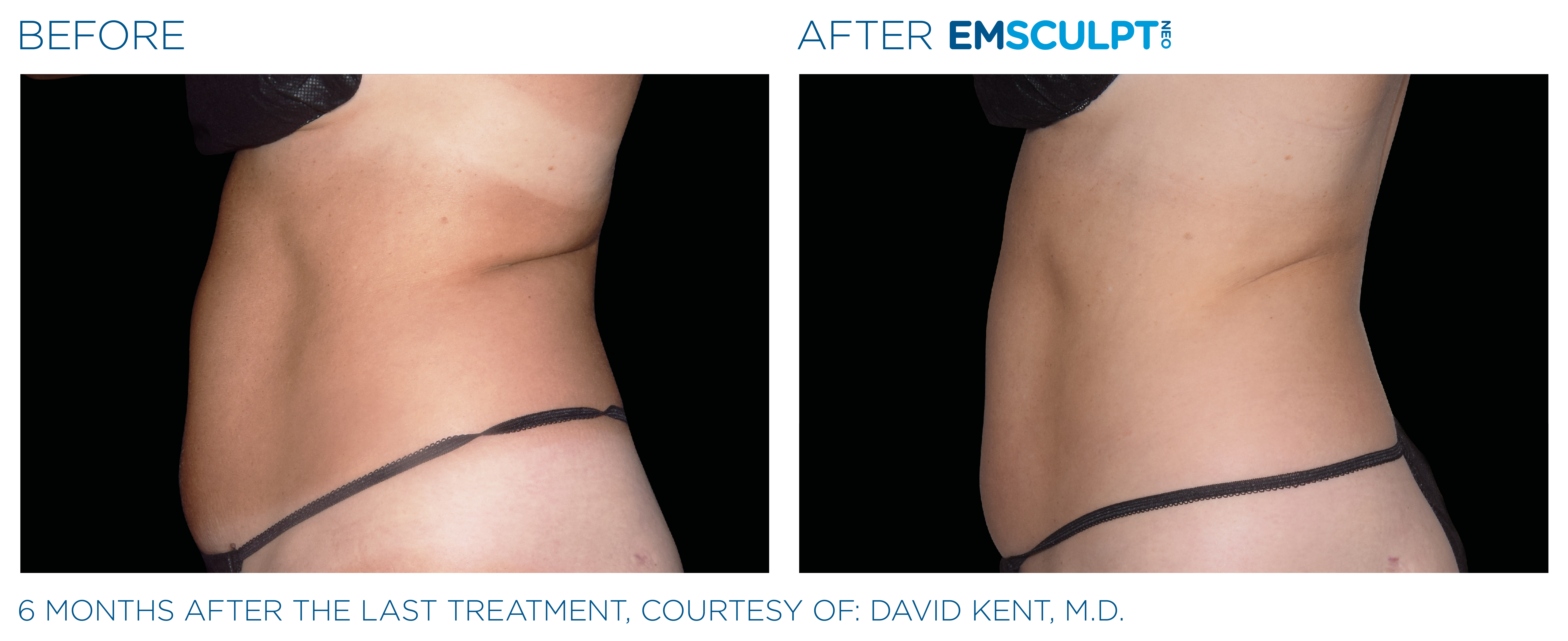 FEMALE ABDOMEN IMPROVEMENT Before & After