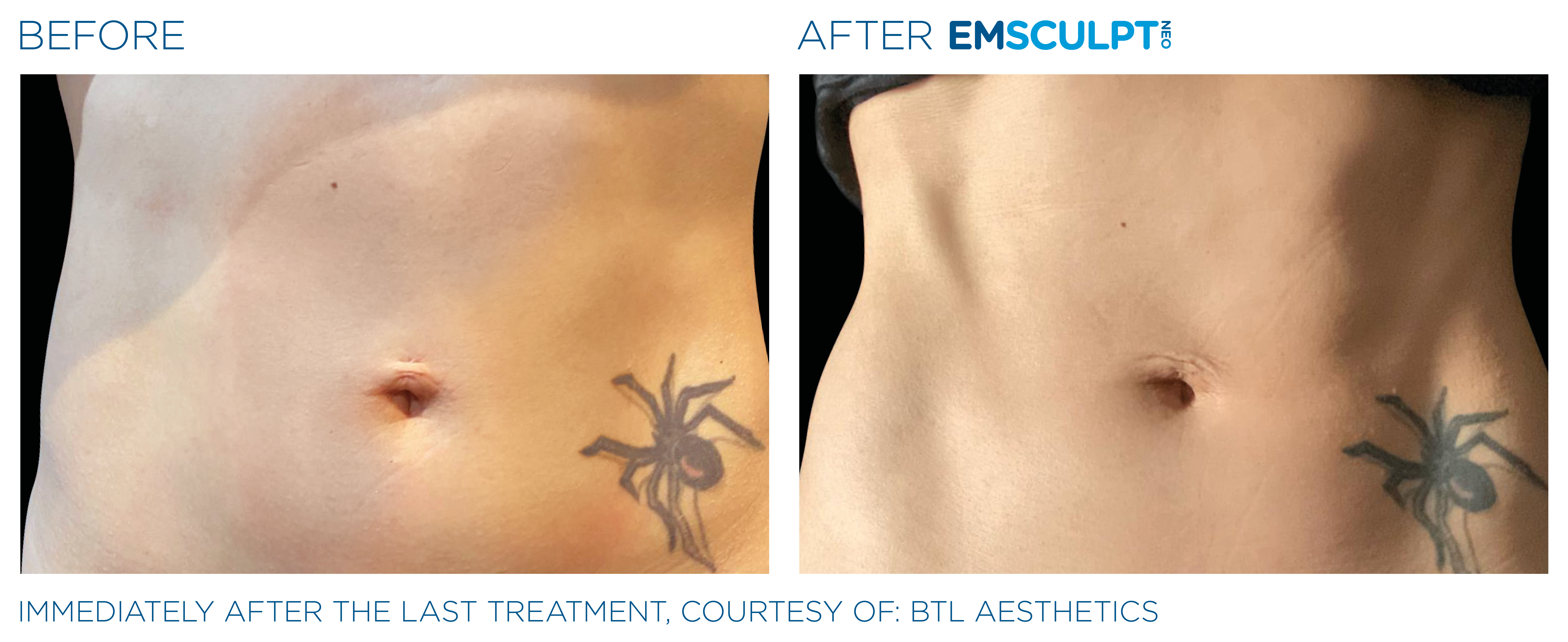 FEMALE ABDOMEN IMPROVEMENT Before & After