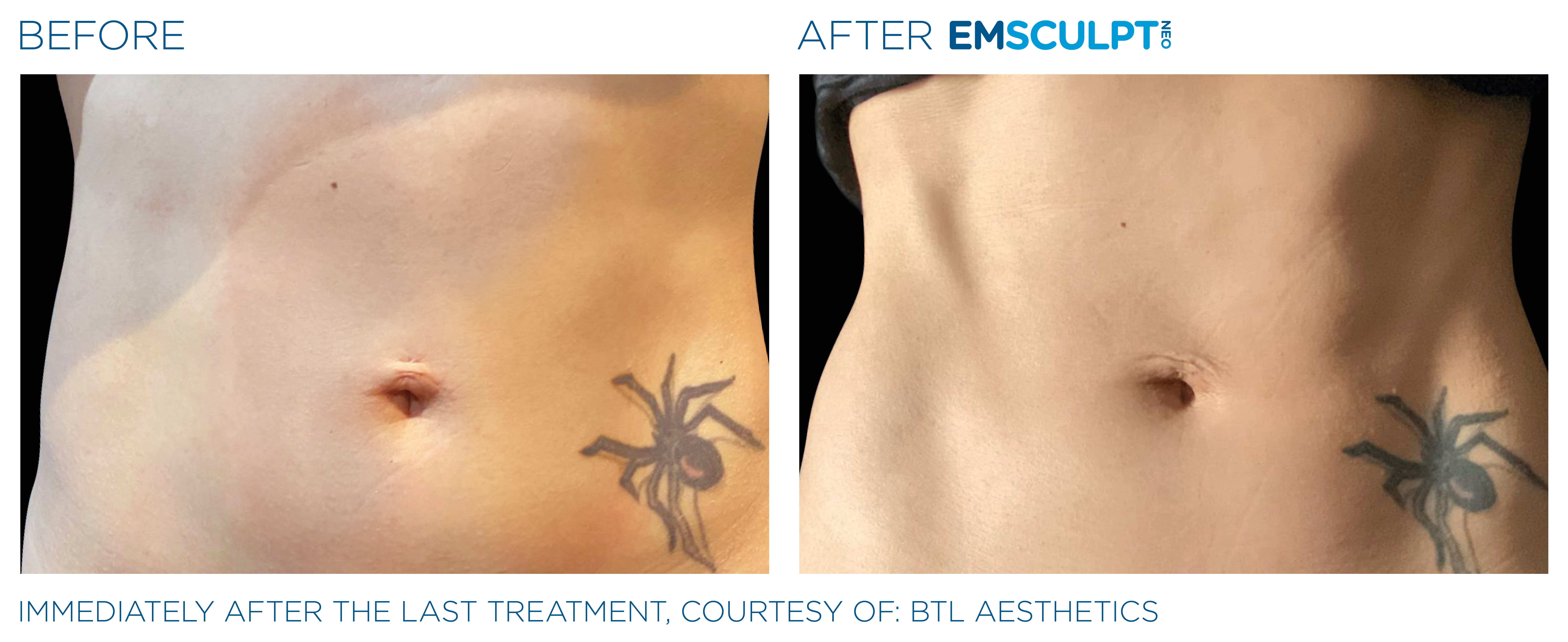 FEMALE ABDOMEN IMPROVEMENT Before & After