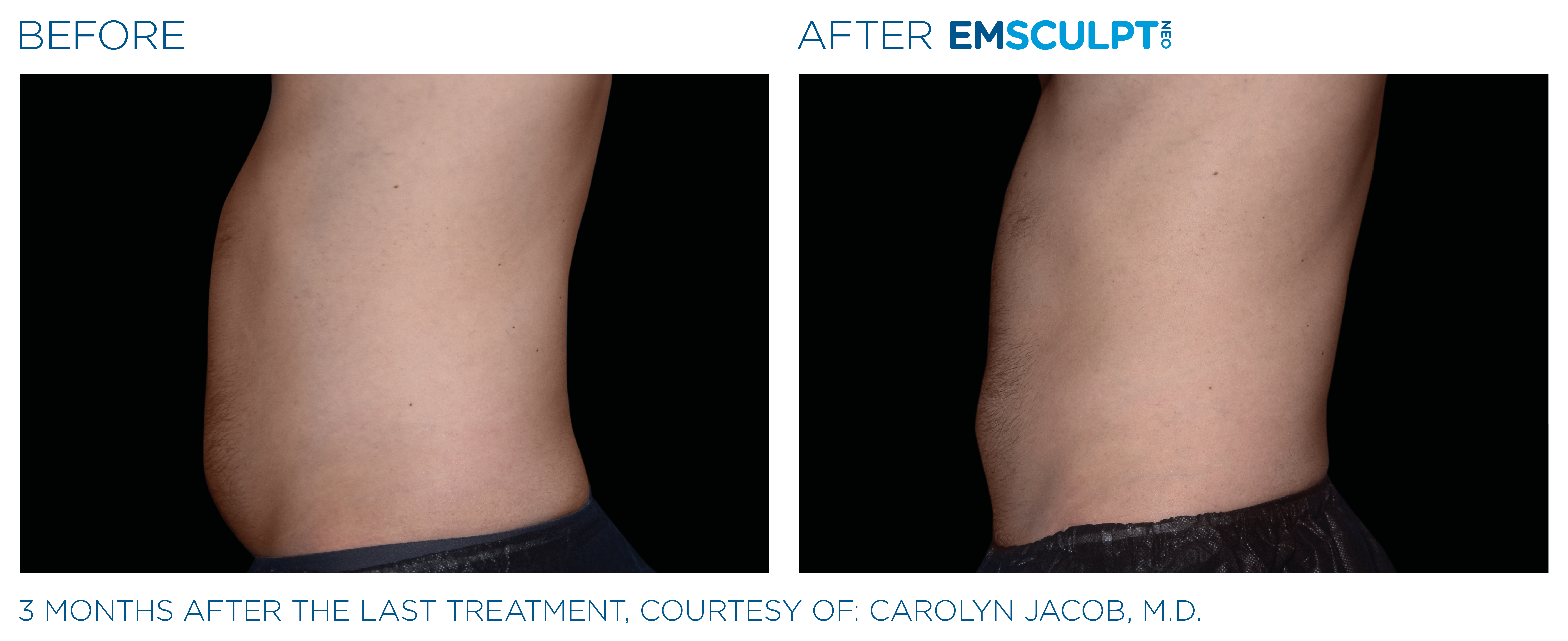 MALE ABDOMEN IMPROVEMENT Before & After