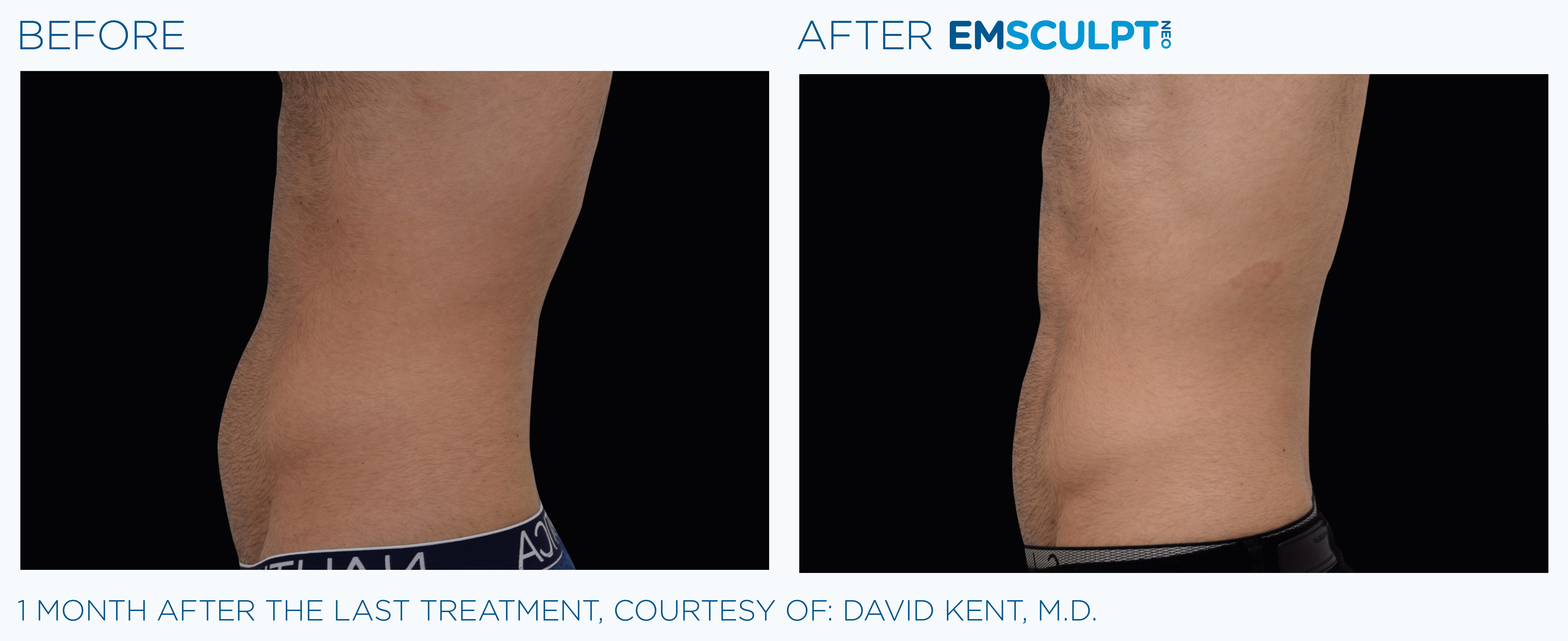 MALE ABDOMEN IMPROVEMENT Before & After